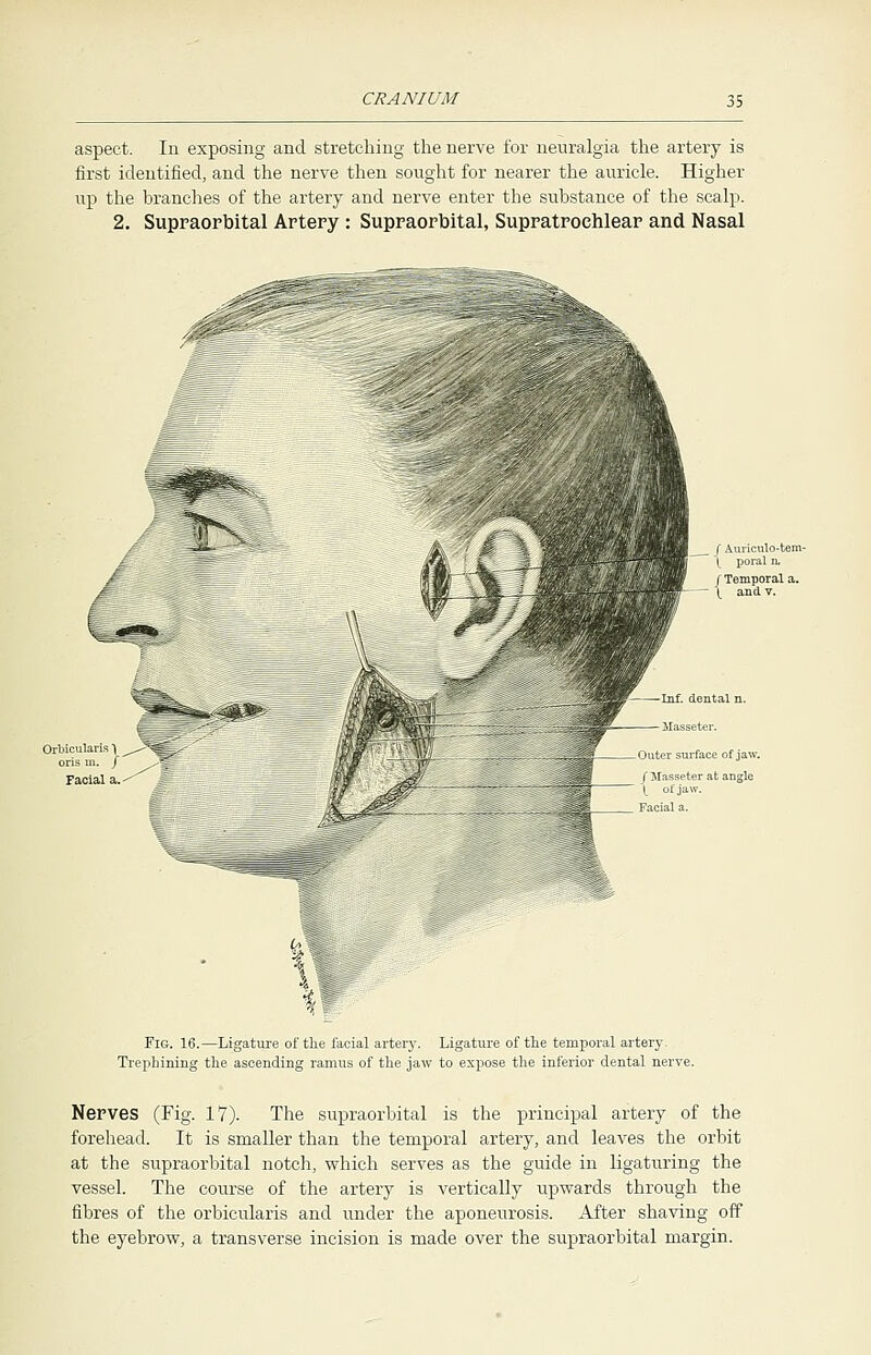 aspect. In exposing and stretching the nerve for neuralgia the artery is first identified, and the nerve then sought for nearer the auricle. Higher up the branches of the artery and nerve enter the substance of the scalp. 2. Supraorbital Artery : Supraorbital, Supratrochlear and Nasal ( Auriculo-tem \ poral n. / Temporal a. \ and v. Orbicularis 1 ^-^^fc / Facial a. Inf. dental n. Masseter. Outer surface of jaw. f^Iasseter at angle \ of jaw. Facial a. Fig. 16.—Ligature of the facial artery. Ligature of the temporal artery. Trephining the ascending ramus of the jaw to expose the inferior dental nerve. Nerves (Fig. 17). The supraorbital is the principal artery of the forehead. It is smaller than the temporal artery, and leaves the orbit at the supraorbital notch, which serves as the guide in ligaturing the vessel. The course of the artery is vertically upwards through the fibres of the orbicularis and under the aponeurosis. After shaving off the eyebrow, a transverse incision is made over the supraorbital margin.