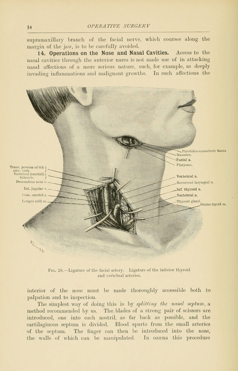 supramaxillary branch of the facial nerve, which courses along the margin of the jaw, is to be carefully avoided. 14. Operations on the Nose and Nasal Cavities. Access to the nasal cavities through the anterior nares is not made use of in attacking nasal affections of a more serious nature, such, for example, as deeply invading innammations and malignant growths. In such affections the ran.ti.l.o-massetmc fascia ilasseter. Facial a. Platysma. Vertebral a. t laryngeal n. Inf. thyroid a. Vertebral a. Thyroid gland. Fig. 28.—Ligature of the facia] artery. Ligature of the inferior thyroid and vertebral arteries. interior of the nose must be made thoroughly accessible both to palpation and to inspection. The simplest way of doing this is by splitting the nasal septum, a method recommended by us. The blades of a strong pair of scissors are introduced, one into each nostril, as far back as possible, and the cartilaginous septum is divided. Blood spurts from the small arteries of the septum. The finger can then be introduced into the nose, the walls of which can be manipulated. In ozsena this procedure