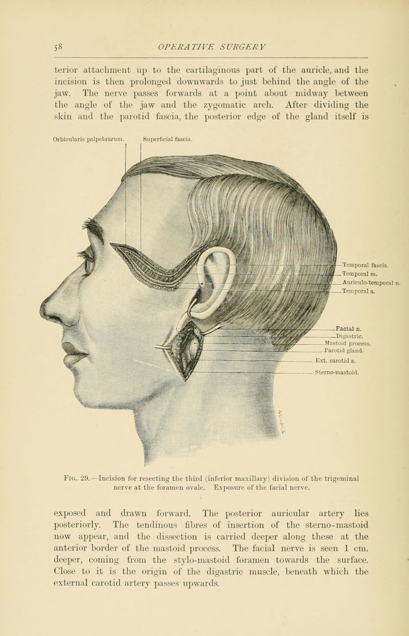 berior attachment up to the cartilaginous part of the auricle, and the incision is then prolonged downwards to just behind the angle of the jaw. The nerve passes forwards at a point about midway between the angle of the jaw and the zygomatic arch. After dividing the skin and the parotid fascia, the posterior edge of the gland itself is Orbicularis palpebrarum. Superficial fascia poral fascia. Temporal m. Auriculotemporal i Temporal a. Mastoid process. Parotid gland. Ext. carotid a. Sterno-mastoid. Fig. 29. — Incision for resecting the third (inferior maxillary) division of the trigeminal nerve at the foramen ovale. Exposure of the facial nerve. exposed and drawn forward. The posterior auricular artery lies posteriorly. The tendinous fibres of insertion of the sterno-mastoid now appear, and the dissection is carried deeper along these at the anterior border of the mastoid process. The facial nerve is seen 1 cm. deeper, coming from the stylo-mastoid foramen towards the surface. Close to it is the origin of the digastric muscle, beneath which the external carotid artery passes upwards.