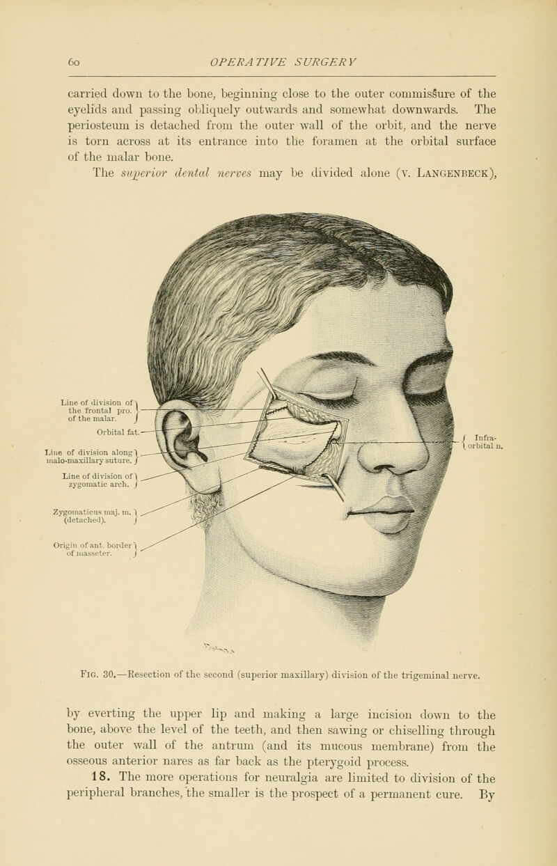 carried down to the bone, beginning close to the outer commissure of the eyelids and passing obliquely outwards and somewhat downwards. The periosteum is detached from the outer wall of the orbit, and the nerve is torn across at its entrance into the foramen at the orbital surface of the malar bone. The superior dented nerves may be divided alone (v. Langenreck), Line of division of \ the frontal pro. |- of the malar. J Line of division along) malo-niaxillary suture. / Line of division of! zygomatic arch. / Fig. 30.—Resection of the second (superior maxillary) division of the trigeminal nerve. by everting the upper lip and making a large incision down to the bone, above the level of the teeth, and then sawing or chiselling through the outer wall of the antrum (and its mucous membrane) from the osseous anterior nares as far back as the pterygoid process. 18. The more operations for neuralgia are limited to division of the peripheral branches, the smaller is the prospect of a permanent cure. By