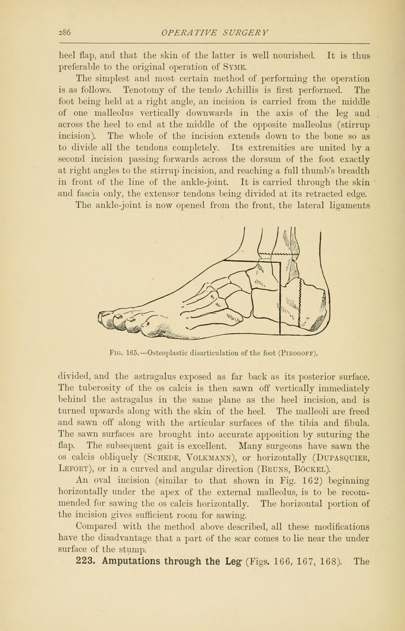 heel flap, and that the skin of the latter is well nourished. It is thus preferable to the original operation of Syme. The simplest and most certain method of performing the operation is as follows. Tenotomy of the tendo Aehillis is first performed. The foot being held at a right angle, an incision is carried from the middle of one malleolus vertically downwards in the axis of the leg and across the heel to end at the middle of the opposite malleolus (stirrup incision). The whole of the incision extends down to the bone so as to divide all the tendons completely. Its extremities are united by a second incision passing forwards across the dorsum of the foot exactly at right angles to the stirrup incision, and reaching a full thumb's breadth in front of the line of the ankle-joint. It is carried through the skin and fascia only, the extensor tendons being divided at its retracted edge. The ankle-joint is now opened from the front, the lateral ligaments Fig. 165.—Osteoplastic disarticulation of the foot (Pieogoff) divided, and the astragalus exposed as far back as its posterior surface. The tuberosity of the os calcis is then sawn off vertically immediately behind the astragalus in the same plane as the heel incision, and is turned upwards along with the skin of the heel. The malleoli are freed and sawn off along with the articular sm-faces of the tibia and fibula. The sawn surfaces are brought into accurate apposition by suturing the flap. The subsequent gait is excellent. Many surgeons have sawn the os calcis obliquely (Schede, Volkmann), or horizontally (Dupasquiee, Lefoet), or in a curved and angular direction (Beuns, BOckel). An oval incision (similar to that shown in Fig. 162) beginning horizontally under the apex of the external malleolus, is to be recom- mended for sawing the os calcis horizontally. The horizontal portion of the incision gives sufficient room for sawing. Compared with the method above described, all these modifications have the disadvantage that a part of the scar comes to lie near the under surface of the stump. 223. Amputations through the Leg1 (Figs. 166, 167, 168). The