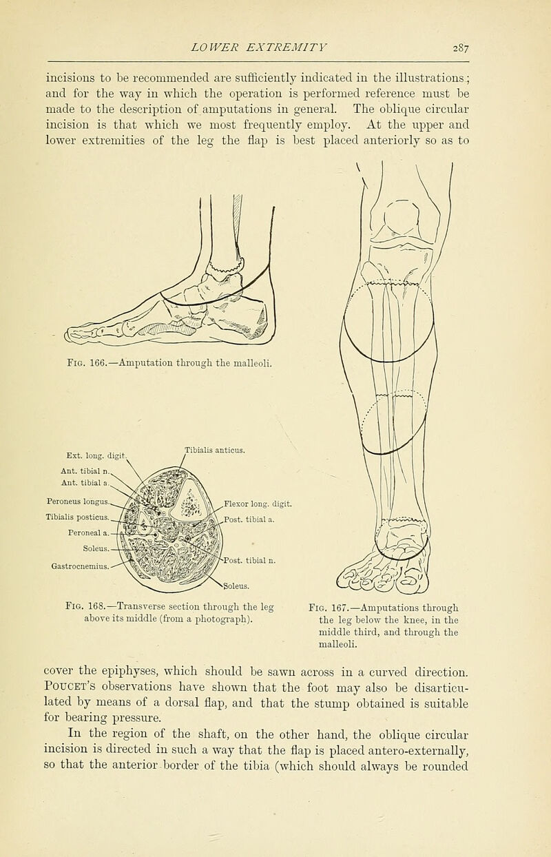 incisions to be recommended are sufficiently indicated in the illustrations; and for the way in which the operation is performed reference must be made to the description of amputations in general. The oblique circular incision is that which we most frequently employ. At the upper and lower extremities of the leg the flap is best placed anteriorly so as to Fig. 166.—Amputation through the malleoli. Tibialis anticus. Flexor long, digit. Post, tibial a. Ext. long, digit Ant. tibial n. Ant. tibial a. Peroneus longus. Tibialis posticus. Peroneal a. Sol. Gastrocnemius Fig. 168.—Transverse section through the leg above its middle (from a photograph). Fig. 167.—Amputations through the leg below the knee, in the middle third, and through the malleoli. cover the epiphyses, which should be sawn across in a curved direction. Potjcet's observations have shown that the foot may also be disarticu- lated by means of a dorsal flap, and that the stump obtained is suitable for bearing pressure. In the region of the shaft, on the other hand, the oblique circular incision is directed in such a way that the flap is placed antero-externally, so that the anterior-border, of the tibia (which shoidd always be rounded