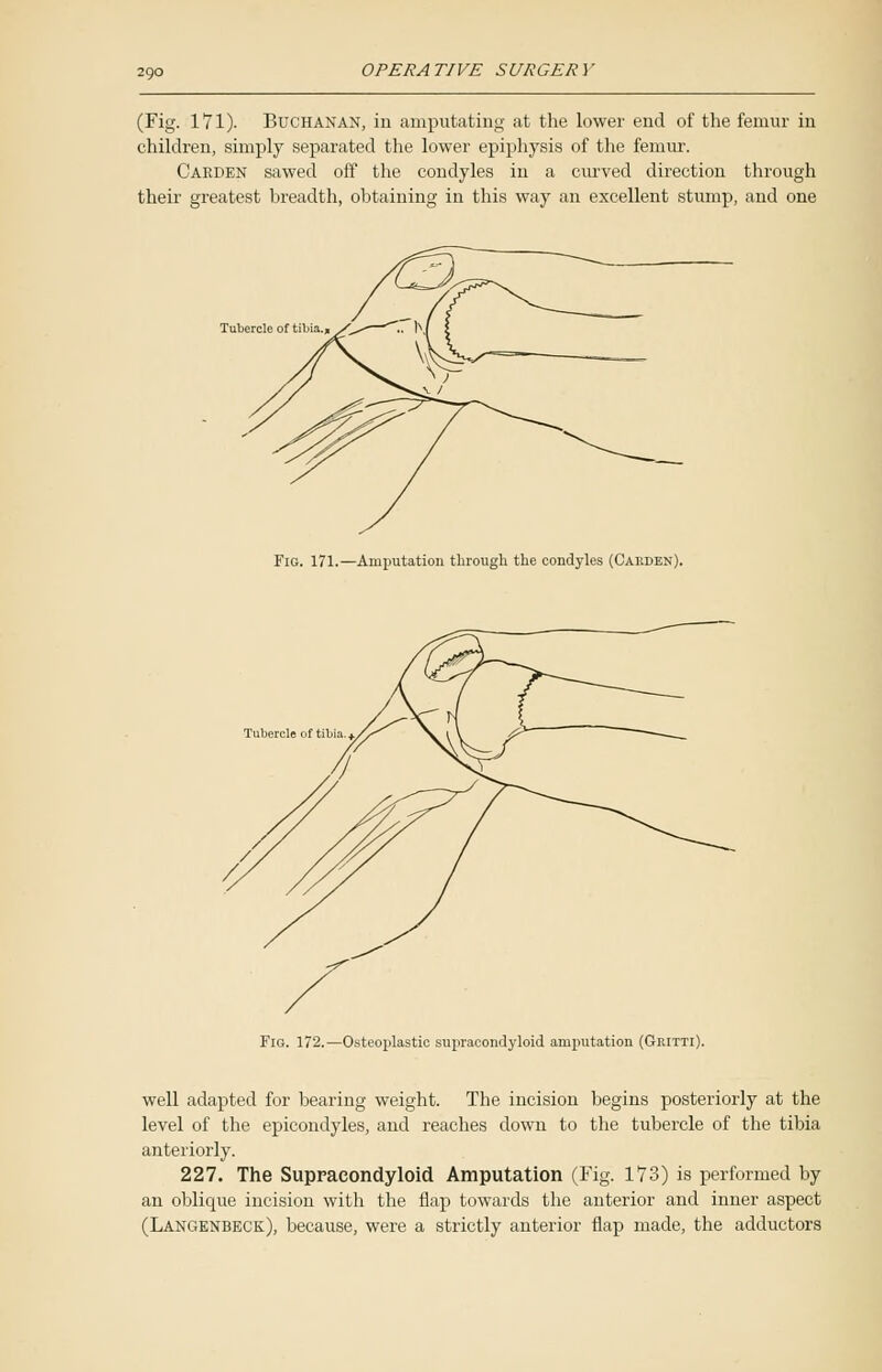 (Fig. 171). Buchanan, in amputating at the lower end of the femur in children, simply separated the lower epiphysis of the femur. Carden sawed off the condyles in a curved direction through their greatest breadth, obtaining in this way an excellent stump, and one Tubercle of tibia. Fig. 171.—Amputation through the condyles (Carden). Fig. 172.—Osteoplastic supracondyloid amputation (Geitti). well adapted for bearing weight. The incision begins posteriorly at the level of the epicondyles, and reaches down to the tubercle of the tibia anteriorly. 227. The Supracondyloid Amputation (Fig. 173) is performed by an oblique incision with the flap towards the anterior and inner aspect (Langenbeck), because, were a strictly anterior flap made, the adductors