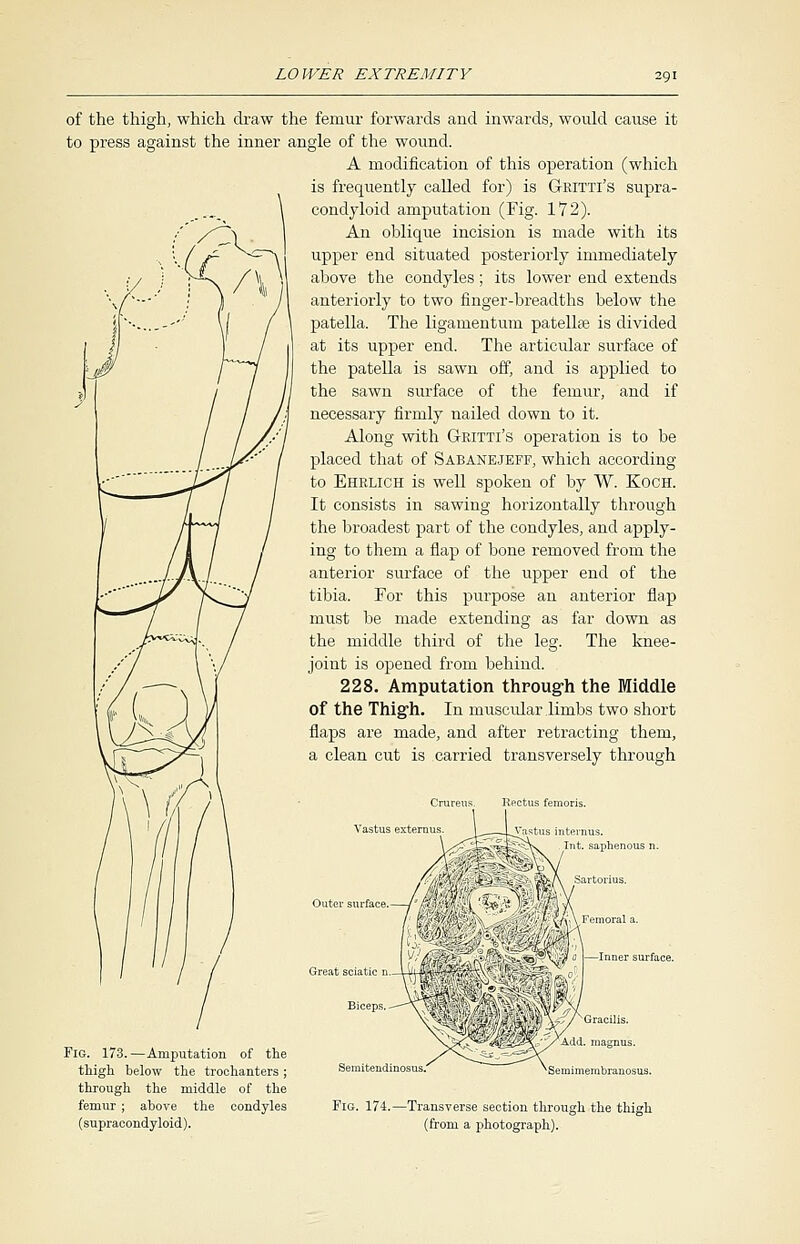 of the thigh, which draw the femur forwards and inwards, would cause it to press against the inner angle of the wound. A modification of this operation (which is frequently called for) is G-kitti's supra- \ condyloid amputation (Fig. 172). / /^~\ An oblique incision is made with its upper end situated posteriorly immediately above the condyles; its lower end extends anteriorly to two finger-breadths below the patella. The ligamentum patellae is divided at its upper end. The articular surface of the patella is sawn off, and is applied to the sawn surface of the femur, and if necessary firmly nailed down to it. Along with Gritti's operation is to be placed that of Sabanejeff, which according to Ehrlich is well spoken of by W. Koch. It consists in sawing horizontally through the broadest part of the condyles, and apply- ing to them a flap of bone removed from the anterior surface of the upper end of the tibia. For this purpose an anterior flap must be made extending as far down as the middle third of the leg. The knee- joint is opened from behind. 228. Amputation through the Middle of the Thigh. In muscular limbs two short a \/ flaps are made, and after retracting them, a clean cut is carried transversely through Crureus. Rectus femoris. Vastus r->:t-'ni]is Outer surface. Fig. 173.—Amputation of the thigh below the trochanters; through the middle of the femur ; above the condyles (supracondyloid). Semitendinosus. Virtus inten: Int. saphenous n. I ^/Y^Femoral a. Inner surface. Scmiineiiiliniin'suy. Fig. 174.—Transverse section through the thigh (from a photograph).