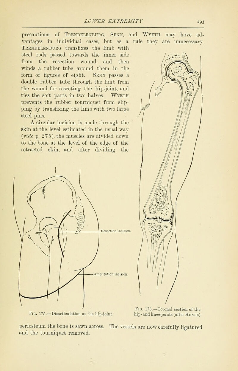 precautions of Trendelenburg, Senn, and Wyeth vantages in individual cases, but as a rule they Trendelenburg transfixes the limb with steel rods passed towards the inner side from the resection wound, and then winds a rubber tube around them in the form of figures of eight. Senn passes a double rubber tube through the limb from the wound for resecting the hip-joint, and ties the soft parts in two halves. Wyeth prevents the rubber tourniquet from slip- ping by transfixing the limb with two large steel pins. A circular incision is made through the skin at the level estimated in the usual way (vide p. 275), the muscles are divided down to the bone at the level of the edge of the retracted skin, and after dividing the may have ad- are unnecessary. Resection incision. Fig, 175.—Disarticulation at the hip-joint. Fig. 176.—Coronal section of the hip- and knee-joints (after Henle). periosteum the bone is sawn across. The vessels are now carefully ligatured and the tourniquet removed.