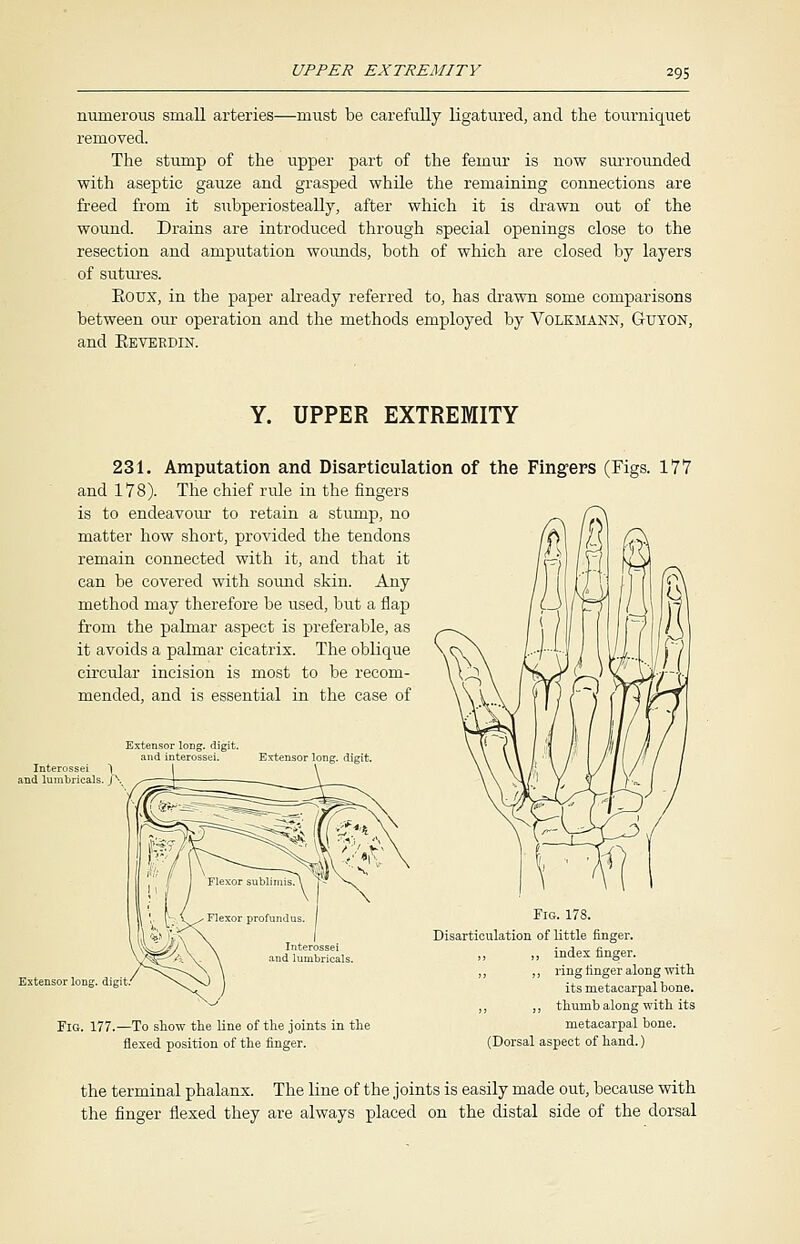 numerous small arteries—must be carefully ligatured, and the tourniquet removed. The stump of the upper part of the femur is now surrounded with aseptic gauze and grasped while the remaining connections are freed from it subperiosteally, after which it is drawn out of the wound. Drains are introduced through special openings close to the resection and amputation wounds, both of which are closed by layers of sutures. Koux, in the paper already referred to, has drawn some comparisons between our operation and the methods employed by Volkmann, Guyon, and Eeverdin. Y. UPPER EXTREMITY 231. Amputation and Disarticulation of the Fingers (Fi and 178). The chief ride in the fingers is to endeavour to retain a stump, no matter how short, provided the tendons remain connected with it, and that it can be covered with sound skin. Any method may therefore be used, but a flap from the palmar aspect is preferable, as it avoids a palmar cicatrix. The oblique circular incision is most to be recom- mended, and is essential in the case of Extensor long, digit. and interossei. Extensor long, digit. gs. 177 Extensor long, digit. Fig. 177.—To show the line of the joints in the flexed position of the finger. Fro. 178. Disarticulation of little finger. „ ,, index finger. „ ,, ring finger along with its metacarpal bone. „ „ thumb along with its metacarpal bone. (Dorsal aspect of hand.) the terminal phalanx. The line of the joints is easily made out, because with the finger flexed they are always placed on the distal side of the dorsal