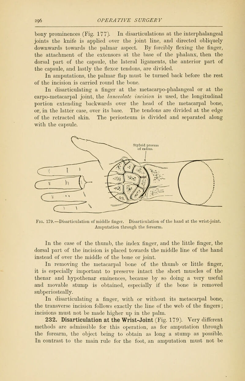 bony prominences (Fig. 177). In disarticulations at the interphalangeal joints the knife is applied over the joint line, and directed obliquely downwards towards the palmar aspect. By forcibly flexing the finger, the attachment of the extensors at the base of the phalanx, then the dorsal part of the capsule, the lateral ligaments, the anterior part of the capsule, and lastly the flexor tendons, are divided. In amputations, the palmar flap must be turned back before the rest of the incision is carried round the bone. In disarticulating a finger at the metacarpo-phalangeal or at the carpo-metacarpal joint, the lanceolate incision is used, the longitudinal portion extending backwards over the head of the metacarpal bone, or, in the latter case, over its base. The tendons are divided at the edge of the retracted skin. The periosteum is divided and separated along with the capsule. Fig. 179.—Disarticulation of middle ringer. Disarticulation of the hand at the wrist-joint. Amputation through the forearm. In the case of the thumb, the index finger, and the little finger, the dorsal part of the incision is placed towards the middle line of the hand instead of over the middle of the bone or joint. In removing the metacarpal bone of the thumb or little finger, it is especially important to preserve intact the short muscles of the thenar and hypothenar eminences, because by so doing a very useful and movable stump is obtained, especially if the bone is removed subperiosteally. In disarticulating a finger, with or without its metacarpal bone, the transverse incision follows exactly the line of the web of the fingers; incisions must not be made higher up in the palm. 232. Disarticulation at the Wrist-Joint (Fig. 179). Very different methods are admissible for this operation, as for amputation through the forearm, the object being to obtain as long a stump as possible. In contrast to the main rule for the foot, an amputation must not be