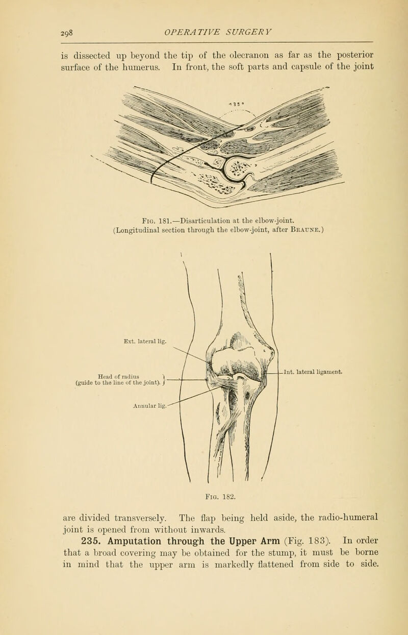 is dissected up beyond the tip of the olecranon as far as the posterior surface of the humerus. In front, the soft parts and capsule of the joint Fig. 181.—Disarticulation at the elbow-joint. (Longitudinal section through the elbow-joint, after Bkaune.) Head of radius (guide to the line of the joint). Int. lateral ligament. are divided transversely. The flap being held aside, the radio-humeral joint is opened from without inwards. 235. Amputation through the Upper Arm (Fig. 183). In order that a broad covering may be obtained for the stump, it must be borne in mind that the upper arm is markedly flattened from side to side.