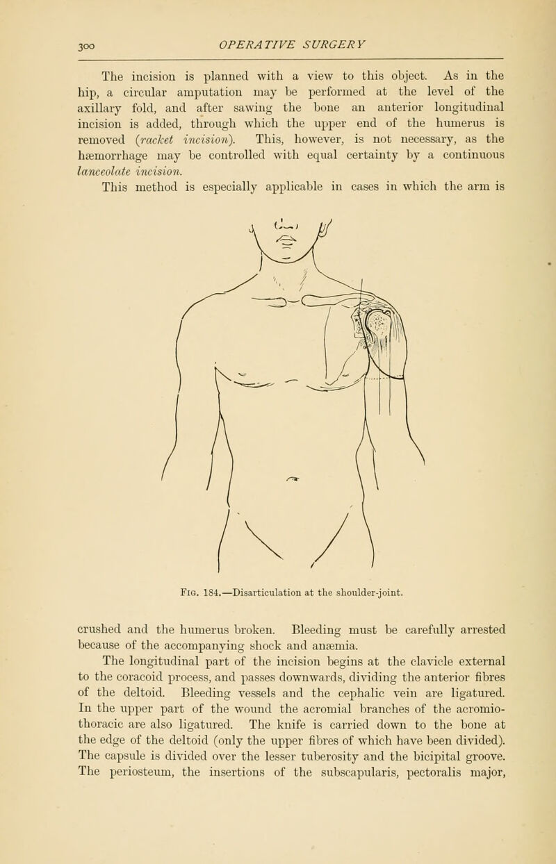 The incision is planned with a view to this object. As in the hip, a circular amputation may be performed at the level of the axillary fold, and after sawing the bone an anterior longitudinal incision is added, through which the upper end of the humerus is removed {racket incision). This, however, is not necessary, as the haemorrhage may be controlled with equal certainty by a continuous lanceolate incision. This method is especially applicable in cases in which the arm is Fig. 184.—Disarticulation at the shoulder-joint. crushed and the humerus broken. Bleeding must be carefully arrested because of the accompanying shock and anaemia. The longitudinal part of the incision begins at the clavicle external to the coracoid process, and passes downwards, dividing the anterior fibres of the deltoid. Bleeding vessels and the cephalic vein are ligatured. In the upper part of the wound the acromial branches of the acromio- thoracic are also ligatured. The knife is carried down to the bone at the edge of the deltoid (only the upper fibres of which have been divided). The capsule is divided over the lesser tuberosity and the bicipital groove. The periosteum, the insertions of the subscapularis, pectoralis major,