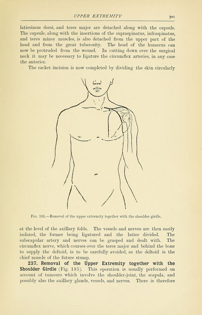 latissimus dorsi, and teres major are detached along with the capsule. The capsule, along with the insertions of the supraspinatus, infraspinatus, and teres minor muscles, is also detached from the upper part of the head and from the great tuberosity. The head of the humerus can now be protruded from the wound. In cutting down over the surgical neck it may be necessary to ligature the circumflex arteries, in any case the anterior. The racket incision is now completed by dividing the skin circularly Fis. 185.—Removal of the upper extremity together -with the shoulder girdle. at the level of the axillary folds. The vessels and nerves are then easily isolated, the former being ligatured and the latter divided. The subscapular artery and nerves can be grasped and dealt with. The circumflex nerve, which courses over the teres major and behind the bone to supply the deltoid, is to be carefully avoided, as the deltoid is the chief muscle of the future stump. 237. Removal of the Upper Extremity together with the Shoulder Girdle (Fig. 185). This operation is usually performed on account of tumours which involve the shoulder-joint, the scapula, and possibly also the axillary glands, vessels, and nerves. There is therefore