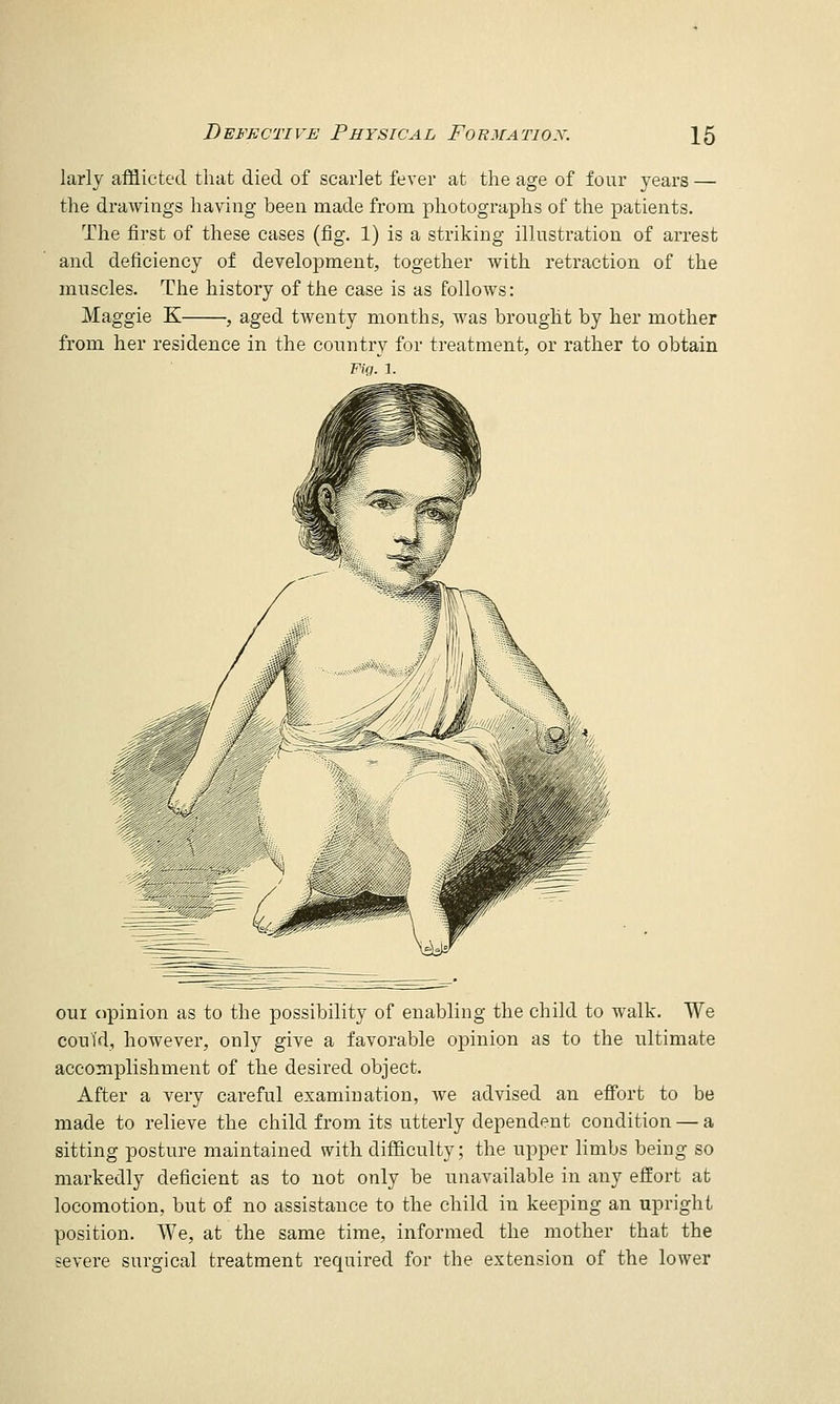 larly afflicted that died of scarlet fever at the age of four years — the drawings having been made from photographs of the patients. The first of these cases (fig. 1) is a striking iUustration of arrest and deficiency of development, together with retraction of the muscles. The history of the case is as follows: Maggie K , aged tAventy months, was brought by her mother from her residence in the country for treatment, or rather to obtain Fig. 1. GUI cipinion as to the possibility of enabling the child to walk. We could, however, only give a favorable opinion as to the ultimate accomplishment of the desired object. After a very careful examination, we advised an efi'ort to be made to relieve the child from its utterly dependent condition — a sitting posture maintained with difficulty; the upper limbs being so markedly deficient as to not only be unavailable in any effort at locomotion, but of no assistance to the child in keeping an upright position. We, at the same time, informed the mother that the severe surgical treatment required for the extension of the lower