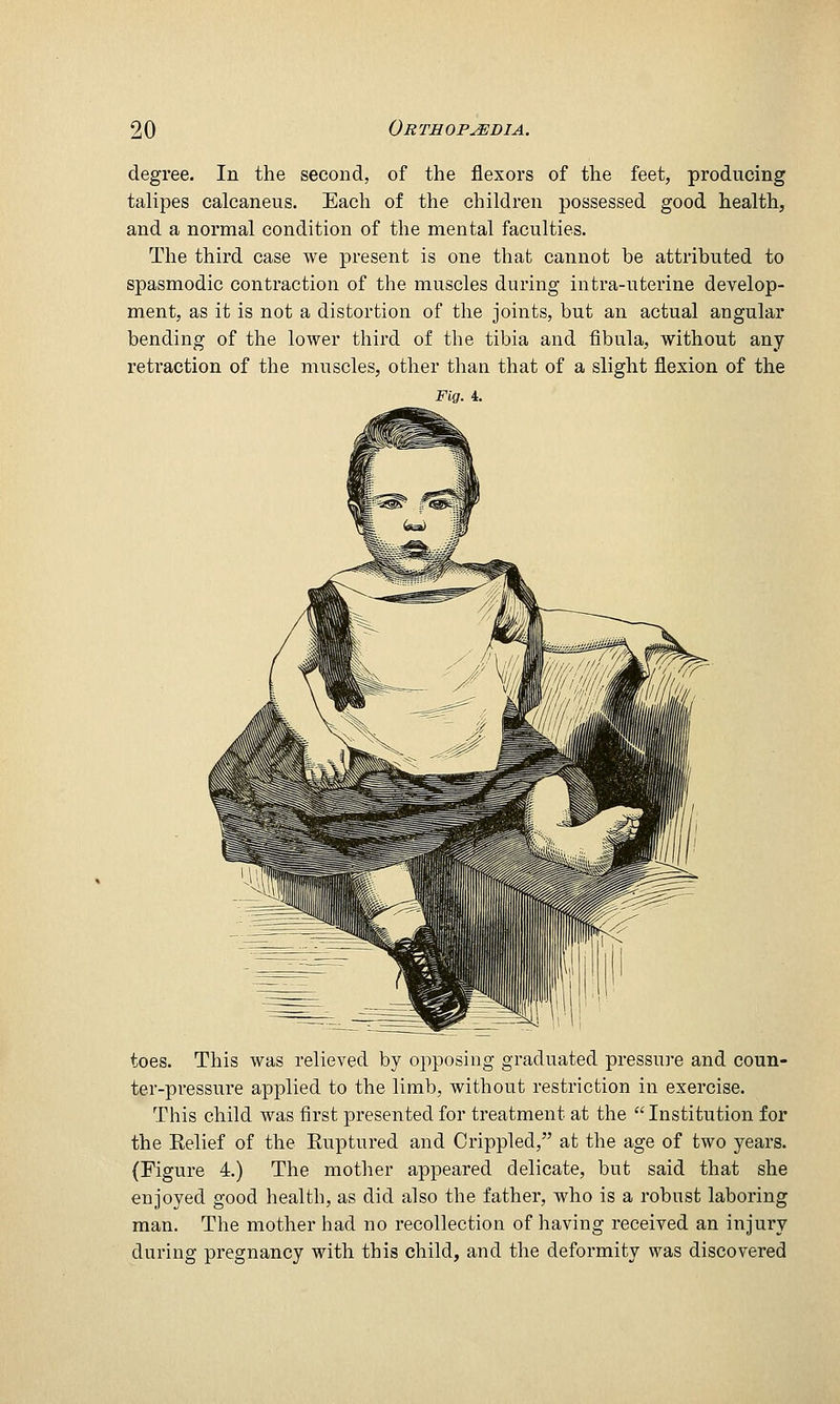 degree. In the second, of the flexors of the feet, producing talipes calcaneus. Each of the children possessed good health, and a normal condition of the mental faculties. The third case we present is one that cannot be attributed to spasmodic contraction of the muscles during intra-uterine develop- ment, as it is not a distortion of the joints, but an actual angular bending of the lower third of the tibia and fibula, without any retraction of the muscles, other than that of a slight flexion of the Fig. 4. toes. This was relieved by opposing graduated pressure and coun- ter-pressure applied to the limb, without restriction in exercise. This child was first presented for treatment at the  Institution for the Eelief of the Ruptured and Crippled, at the age of two years. (Figure 4.) The mother appeared delicate, but said that she enjoyed good health, as did also the father, who is a robust laboring man. The mother had no recollection of having received an injury during pregnancy with this child, and the deformity was discovered