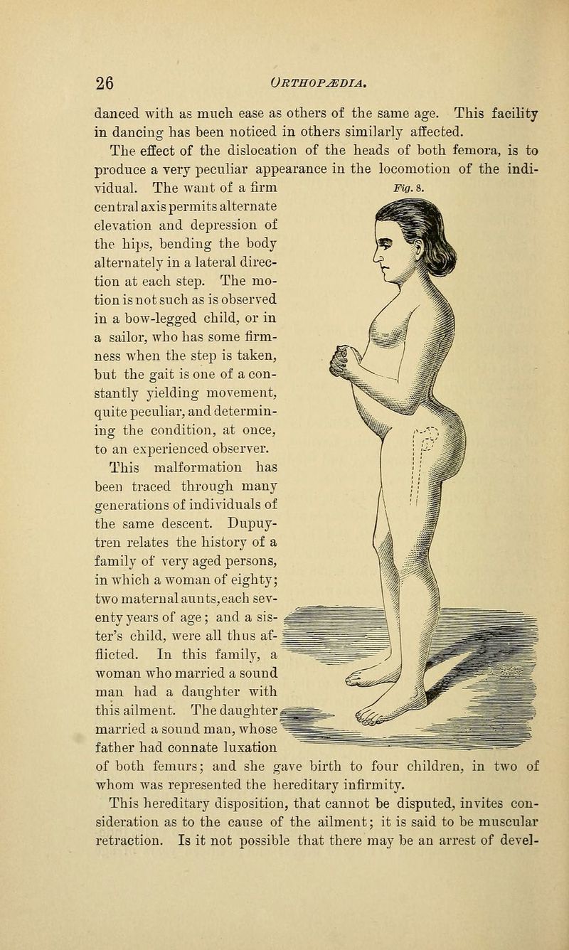 danced with as much ease as others of the same age. This facility in dancing has been noticed in others similarly affected. The effect of the dislocation of the heads of both femora, is to produce a yery jDeculiar appearance in the locomotion of the indi- vidual. The want of a firm mg.&. central axis permits alternate elevation and depression of the hips, bending the body alternately in a lateral direc- tion at each step. The mo- tion is not such as is observed in a bow-legged child, or in a sailor, who has some firm- ness when the step is taken, but the gait is one of a con- stantly yielding movement, quite peculiar, and determin- ing the condition, at once, to an experienced observer. This malformation has been traced through many generations of individuals of the same descent. Dupuy- tren relates the history of a family of very aged persons, in which a woman of eighty; two maternal aunts,each sev- enty years of age; and a sis- ter's child, were all thus af- flicted. In this family, a woman who married a sound man had a daughter with this ailment. The daughter^^^^ married a sound man, whose father had connate luxation of both femurs; and she gave birth to four children, in two of whom was represented the hereditary infirmity. This hereditary disposition, that cannot be disputed, invites con- sideration as to the cause of the ailment; it is said to be muscular retraction. Is it not possible that there may be an arrest of devel-