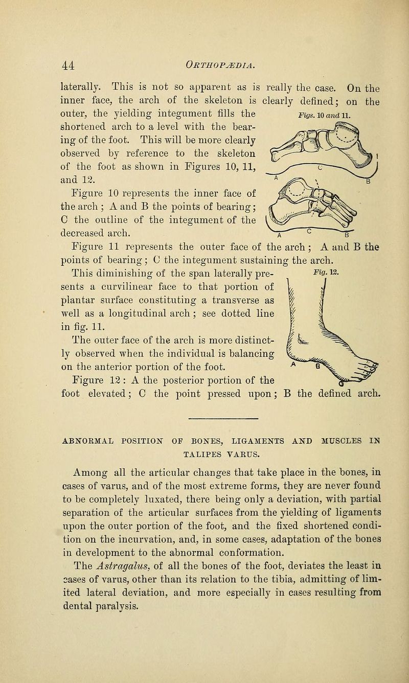laterally. This is not so apparent as is really the ease. On the inner face, the arch of the skeleton is clearly defined; on the outer, the yielding integument fills the Figs.KSanan. shortened arch to a level with the bear- ing of the foot. This will be more clearly observed by reference to the skeleton of the foot as shown in Figures 10, 11, and 13. Figure 10 represents the inner face of the arch ; A and B the points of bearing; C the outline of the integument of the decreased arch. Figure 11 represents the outer face of the arch; A and B the points of bearing; C the integument sustaining the arch. This diminishing of the span laterally pre- sents a curvilinear face to that portion of plantar surface constituting a transverse as well as a longitudinal arch; see dotted line in fig. 11. The outer face of the arch is more distinct- ly observed when the individual is balancing on the anterior portion of the foot. Figure 12 : A the posterior portion of the foot elevated; C the point pressed upon; Fig. 12. B the defined arch. ABJifORMAL POSITION OF BONES, LIGAMENTS AND MUSCLES IN TALIPES VARUS. Among all the articular changes that take place in the bones, in cases of varus, and of the most extreme forms, they are never found to be completely luxated, there being only a deviation, with partial separation of the articular surfaces from the yielding of ligaments upon the outer portion of the foot, and the fixed shortened condi- tion on the incurvation, and, in some cases, adaptation of the bones in development to the abnormal conformation. The Astragalus, of all the bones of the foot, deviates the least in oases of varus, other than its relation to the tibia, admitting of lim- ited lateral deviation, and more especially in cases resulting from dental paralysis.
