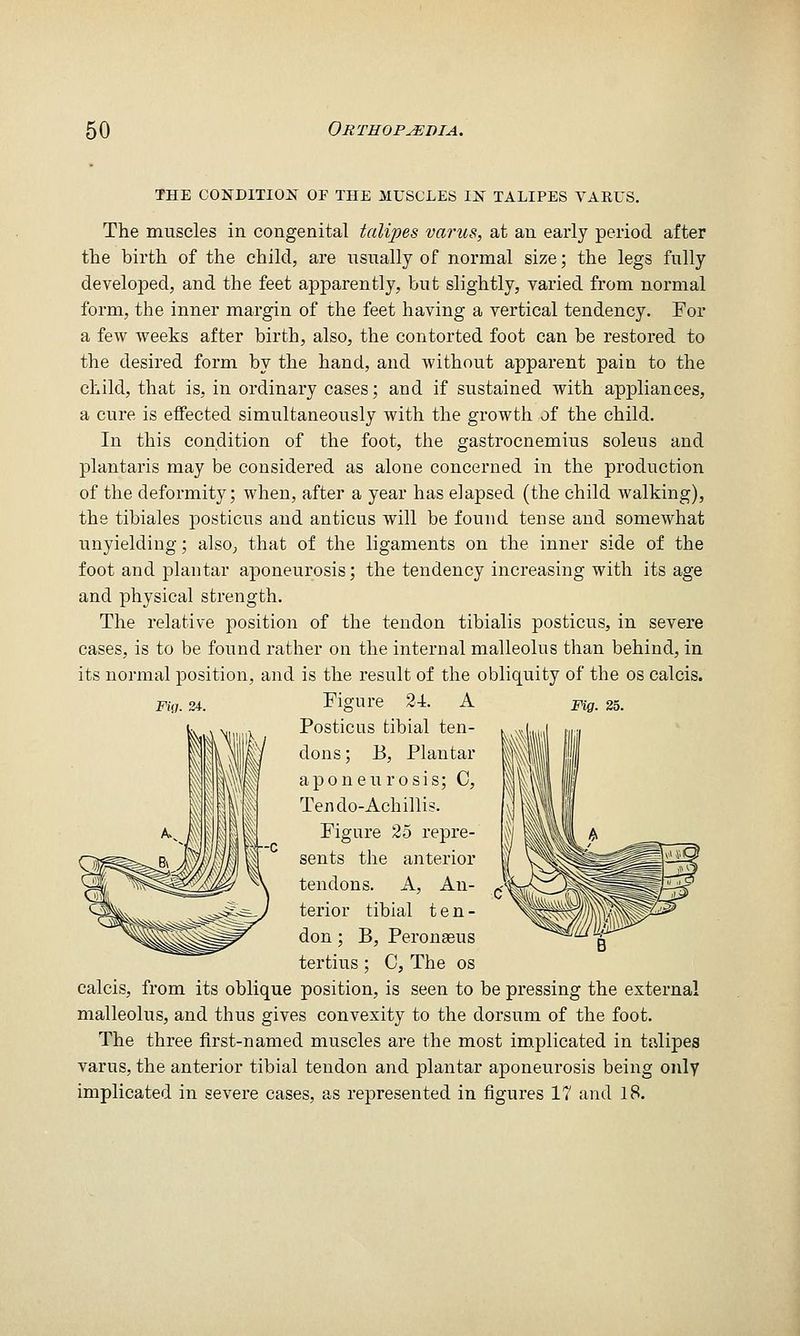 THE CONDITION OF THE MUSCLES IN TALIPES VARUS. The muscles in congenital talipes varus, at an early period after the birth of the child, are nsnally of normal size; the legs fully developed, and the feet apparently, but slightly, varied from normal form, the inner margin of the feet having a vertical tendency. For a few weeks after birth, also, the contorted foot can be restored to the desired form by the hand, and without apparent pain to the child, that is, in ordinary cases; and if sustained with appliances, a cure is effected simultaneously with the growth of the child. In this condition of the foot, the gastrocnemius soleus and plantaris may be considered as alone concerned in the production of the deformity; when, after a year has elapsed (the child walking), the tibiales posticus and anticus will be found tense and somewhat unyielding; also^ that of the ligaments on the inner side of the foot and plantar aponeurosis; the tendency increasing with its age and physical strength. The relative position of the tendon tibialis posticus, in severe cases, is to be found rather on the internal malleolus than behind, in its normal position, and is the result of the obliquity of the os calcis. Figure 24. A Posticus tibial ten- dons ; B, Plantar aponeurosis; C, Tendo-Achillis. Figure 25 repre- sents the anterior tendons. A, An- terior tibial t e n - don; B, Peronseus tertius ; C, The os calcis, from its oblique position, is seen to be pressing the external malleolus, and thus gives convexity to the dorsum of the foot. The three first-named muscles are the most implicated in talipes varus, the anterior tibial tendon and plantar aponeurosis being only implicated in severe cases, as represented in figures 17 and 18. Fh). 24. Fig. 25.