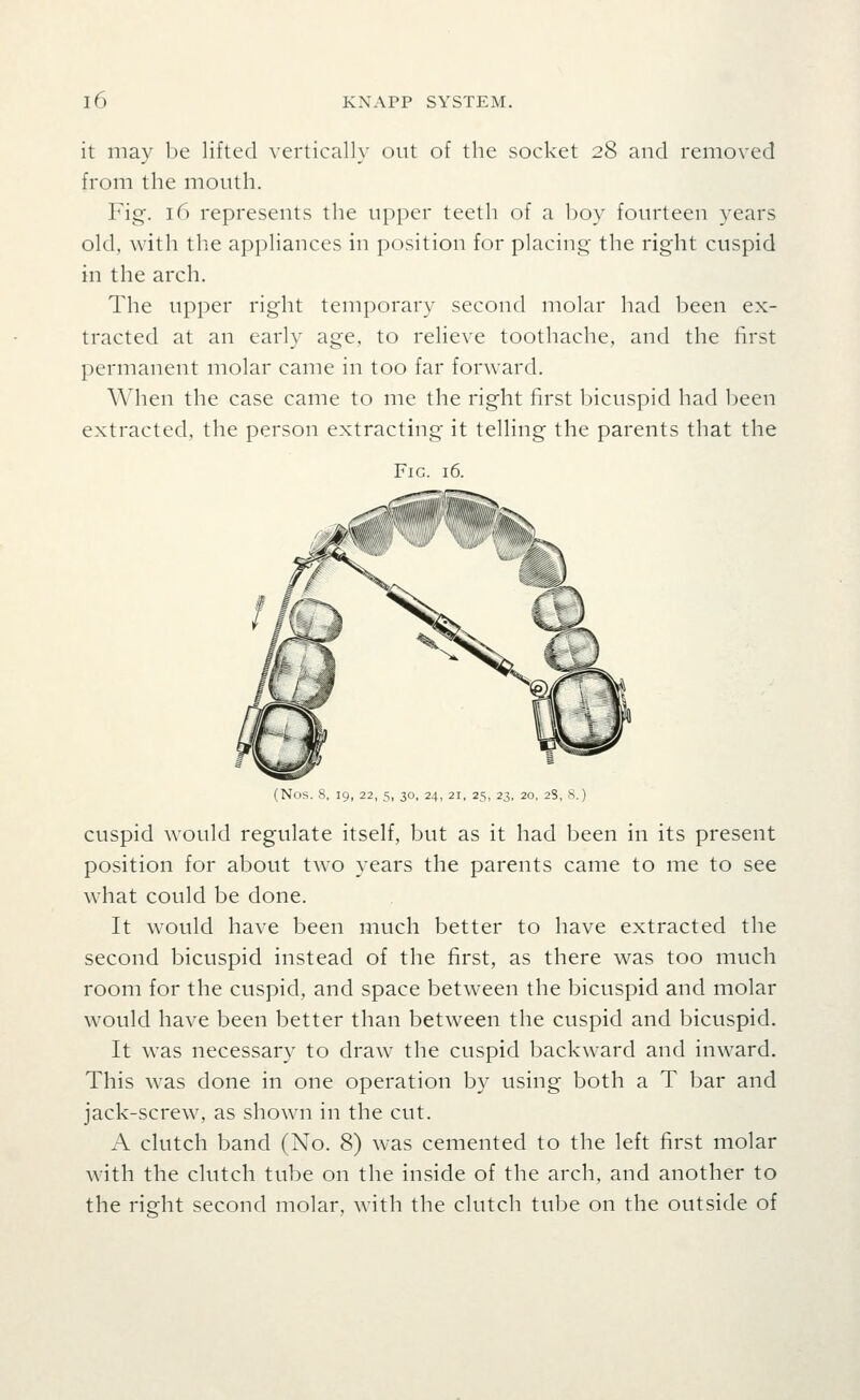 it may be lifted vertically out of the socket 28 and removed from the mouth. Fig. 16 represents the upper teeth of a boy fourteen years old, with the appliances in position for placing the right cuspid in the arch. The upper right temporary second molar had been ex- tracted at an early age, to relieve toothache, and the first permanent molar came in too far forward. When the case came to me the right first bicuspid had been extracted, the person extracting it telling the parents that the Fir;. 16. (Nos. 8, 19, 22, 5, 30, 24, 21, 25, 23, 20, 28, S.) cuspid would regulate itself, but as it had been in its present position for about two years the parents came to me to see what could be done. It would have been much better to have extracted the second bicuspid instead of the first, as there was too much room for the cuspid, and space between the bicuspid and molar would have been better than between the cuspid and bicuspid. It was necessary to draw the cuspid backward and inward. This w'as done in one operation by using both a T bar and jack-screw, as shown in the cut. A clutch band (No. 8) was cemented to the left first molar with the clutch tube on the inside of the arch, and another to the right second molar, with the clutch tube on the outside of