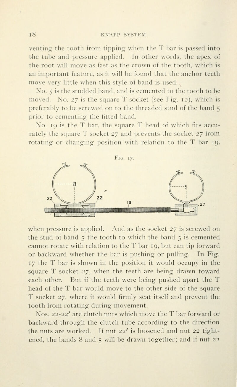 venting the tooth from tipping when the T bar is passed into the tul)e and pressnre apphed. In other words, the apex of the root wih move as fast as the crown of the tooth, which is an important feature, as it will be found that the anchor teeth move very little when this style of band is used. ^ No. 5 is the studded band, and is cemented to the tooth to be moved. No. 27 is the square T socket (see Fig. 12), which is preferably to be screwed on to the threaded stud of the l)and 5 prior to cementing the fitted band. No. 19 is the T 1)ar, the square T head of which fits accu- rately the square T socket 27 and prevents the socket 27 from rotating or changing position with relation to the T l)ar 19. Fig. 17. when pressure is applied. And as the socket 27 is screwed on the stud of band 5 the tooth to which the band 5 is cemented cannot rotate with relation to the T bar 19, but can tip forward or backward whether the bar is pushing or pulling. In Fig. 17 the T bar is shown in the position it would occupy in the square T socket 27, when the teeth are being drawn toward each other. But if the teeth were being pushed apart the T head of the T bar would move to the other side of the square T socket 27, where it would firmly seat itself and prevent the tooth from rotating during movement. Nos. 22-22' are clutch nuts which move the T bar forward or backward through the clutch tube according to the direction the nuts are worked. If nut 22' is loosened and nut 22 tight- ened, the bands 8 and 5 will be drawn together; and if nut 22