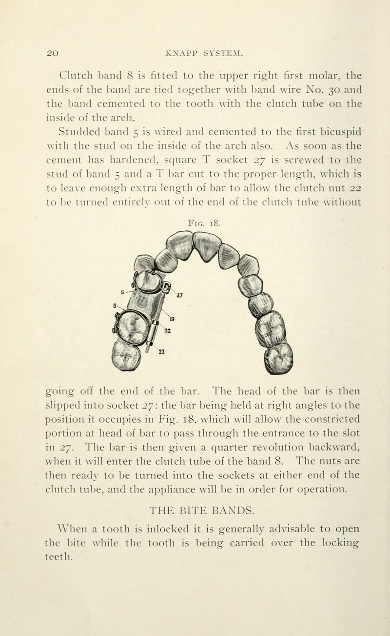 Clutch band 8 is fitted to the upper right hrst molar, the ends of the band are tied together with band wire No. 30 and the band cemented to the tooth with the clutch tube on the inside of the arch. Studded band 5 is wired and cemented to the first bicuspid with the stud on the inside of the arch also. As soon as the cement has hardened, square T socket 27 is screwed to the stud of band 5 and a T bar cut to the proper length, which is to leave enough extra length of bar to allow the clutch nut 22 to be turned entirely oiu of the end of the clutch tulje without Fig. 18. going off. the end of the bar. The head of the bar is then slipped into socket 2/: the bar being held at right angles to the position it occupies in Fig. 18, which will allow the constricted portion at head of bar to pass through the entrance to the slot in 27. The bar is then given a quarter revolution backward, when it will enter the clutch tube of the band 8. The nuts are then ready to be turned into the sockets at either end of the clutch tube, and the appliance will be in order for operation. THE BITE BANDS. When a tooth is inlocked it is generally advisable to open the bite while the tooth is being carried over the locking teeth.