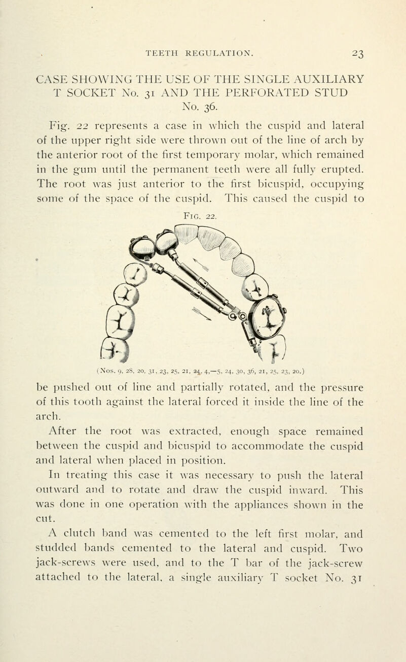 CASE SHOWING THE USE OF THE SINGLE AUXILIARY T SOCKET No. 31 AND THE PERFORATED STUD No. 36. Fig. 22 represents a case in which the cuspid and lateral of the upper right side were thrown out of the hue of arch by the anterior root of the first temporary molar, which remained in the gum until the ]:)ermanent teeth were all fully erupted. The root was just anterior to the first bicuspid, occupying some of the space of the cuspid. This caused the cuspid to Fig. 22. (.Nos. 9, 28, 20, 31, 23, 25, 21, 24, 4,-5, 24, 30, 36, 21, 25, 23, 20.) be pushed out of line and partially rotated, and the pressure of this tooth against the lateral forced it inside the line of the arch. After the root was extracted, enough space remained between the cuspid and bicuspid to accommodate the cuspid and lateral when placed in position. In treating this case it w^as necessary to push the lateral outward and to rotate and draw the cuspid inward. This was done in one operation with the appliances shown in the cut. A clutch band was cemented to the left first molar, and studded bands cemented to the lateral and cuspid. Two jack-screws were used, and to the T bar of the jack-screw attached to the lateral, a single auxiliary T socket No. 31