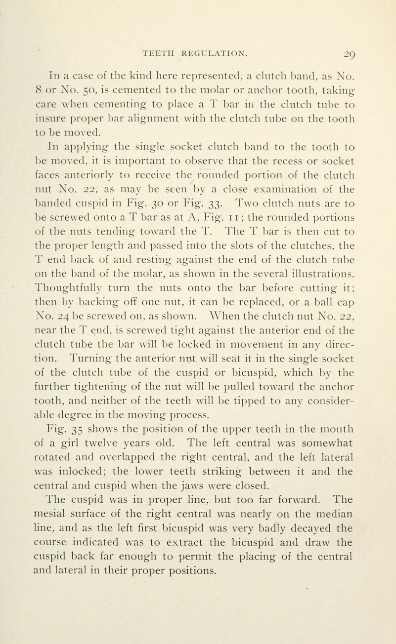 In a case of the kind here represented, a chitch band, as No. 8 or No. 50, is cemented to the molar or anchor tooth, taking- care when cementing to place a T bar in the chitch tnbe to insure proper bar alignment with the clutch tube on the tooth to be moved. In applying- the single socket clutch band to the tooth to be moved, it is important to observe that the recess or socket faces anteriorly to receive the roimded portion of the clutch nut No. 22, as may be seen by a close examination of the banded cuspid in Fig. 30 or Fig. 33. Two clutch nuts are to be screwed onto a T bar as at A, Fig. 11; the rounded portions of the nuts tending toward the T. The T bar is then cut to the proper length and passed into the slots of the clutches, the T end back of and resting against the end of the clutch tube on the band of the molar, as shown in the several illustrations. Thoughtfully turn the nuts onto the bar before cutting it; then by backing off one nut, it can be replaced, or a ball cap No. 24 be screwed on, as shown. When the clutch nut No. 22, near the T end, is screwed tight against the anterior end of the clutch tube the bar will be locked in movement in any direc- tion. Turning the anterior nut will seat it in the single socket of the clutch tube of the cuspid or bicuspid, which by the further tightening of the nut will be pulled toward the anchor tooth, and neither of the teeth will be tipped to any consider- able degree in the moving process. Fig. 35 shows the position of the upper teeth in the mouth of a girl twelve years old. The left central was somewhat rotated and overlapped the right central, and the left lateral was inlocked; the lower teeth striking between it and the central and cuspid when the jaws were closed. The cuspid was in proper line, but too far forward. The mesial surface of the right central was nearly on the median line, and as the left first bicuspid was very badly decayed the course indicated was to extract the bicuspid and draw the cuspid back far enough to permit the placing of the central and lateral in their proper positions.