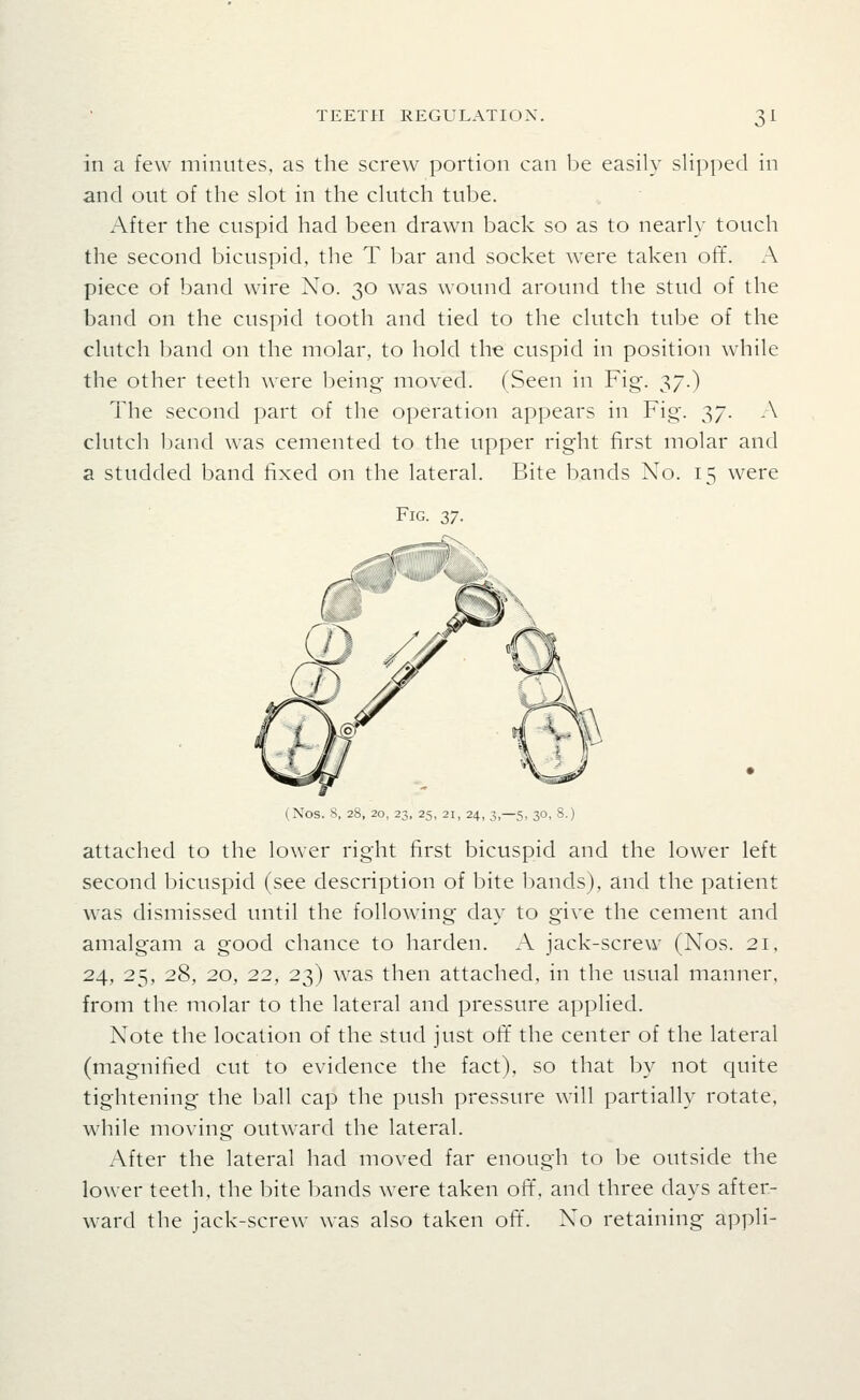 in a few minutes, as the screw portion can be easily slipped in and out of the slot in the clutch tube. After the cuspid had been drawn back so as to nearly touch the second bicuspid, the T bar and socket were taken off. A piece of band wire Xo. 30 was wound around the stud of the band on the cuspid tooth and tied to the clutch tube of the clutch band on the molar, to hold the cuspid in position while the other teeth were being moved. (Seen in Fig. 37.) The second part of the operation appears in Fig. 37. A clutch band was cemented to the upper right first molar and a studded band fixed on the lateral. Bite bands No. 15 were Fig. zi- F (Nos. S, 28, 20, 23, 25, 21, 24, 3,—5, 30, S.) attached to the lower right first bicuspid and the lower left second bicuspid (see description of bite bands), and the patient was dismissed until the following day to give the cement and amalgam a good chance to harden. A jack-screw (Nos. 21. 24, 25, 28, 20, 22, 23) was then attached, in the usual manner, from the molar to the lateral and pressure applied. Note the location of the stud just oti the center of the lateral (magnified cut to evidence the fact), so that by not quite tightening the ball cap the push pressure will partially rotate, while moving outward the lateral. After the lateral had moved far enough to be outside the lower teeth, the bite bands were taken off, and three days after- ward the jack-screw was also taken oft'. No retaining appli-