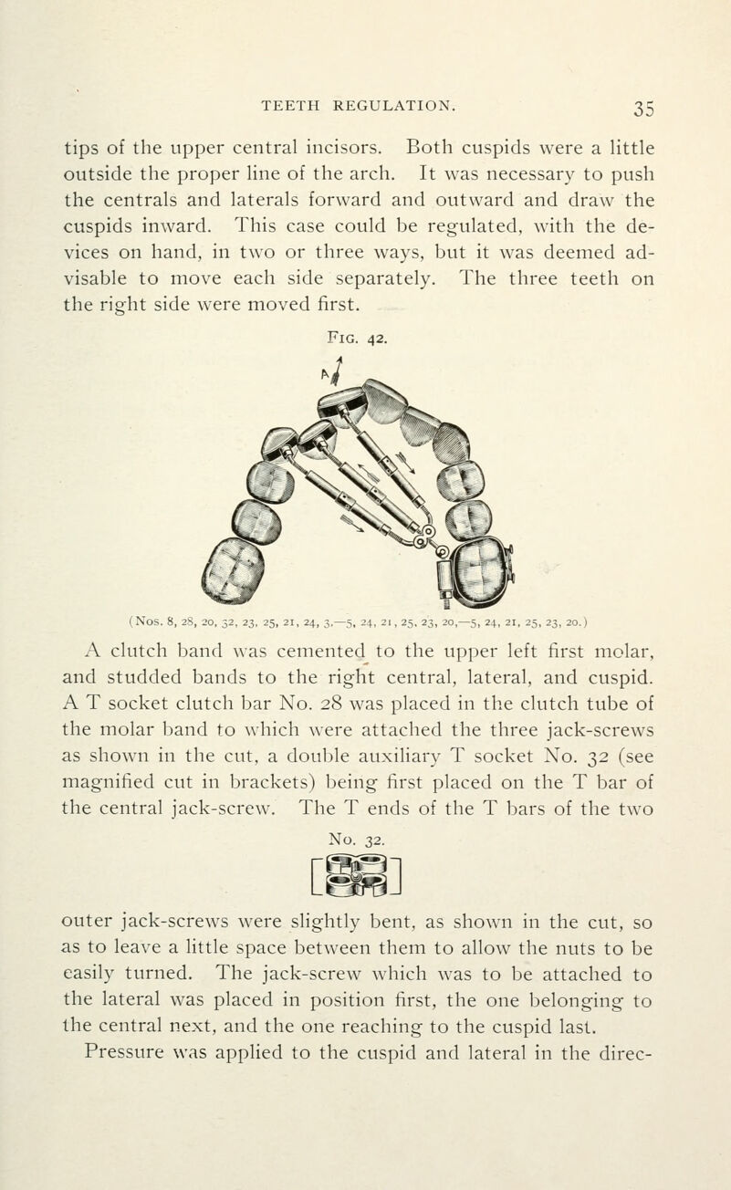 tips of the upper central incisors. Both cuspids were a Httle outside the proper line of the arch. It was necessary to push the centrals and laterals forward and outward and draw the cuspids inward. This case could be regulated, with the de- vices on hand, in two or three ways, but it was deemed ad- visable to move each side separately. The three teeth on the right side were moved first. (Nos. 8, 28, 20, 32, 23, 25, 21, 24, 3,-5, 24, 21, 25, 23, 20,-5, 24, 21, 25, 23, 20.) A clutch band was cemented to the upper left first molar, and studded bands to the right central, lateral, and cuspid. A T socket clutch bar No. 28 was placed in tlie clutch tube of the molar band to which were attached the three jack-screws as shown in the cut, a double auxiliary T socket No. 32 (see magnified cut in brackets) being first placed on the T bar of the central jack-screw. The T ends of the T bars of the two No. 32. outer jack-screws were slightly bent, as shown in the cut, so as to leave a little space between them to allow the nuts to be easily turned. The jack-screw which was to be attached to the lateral was placed in position first, the one belonging to the central next, and the one reaching to the cuspid last. Pressure was applied to the cuspid and lateral in the direc-