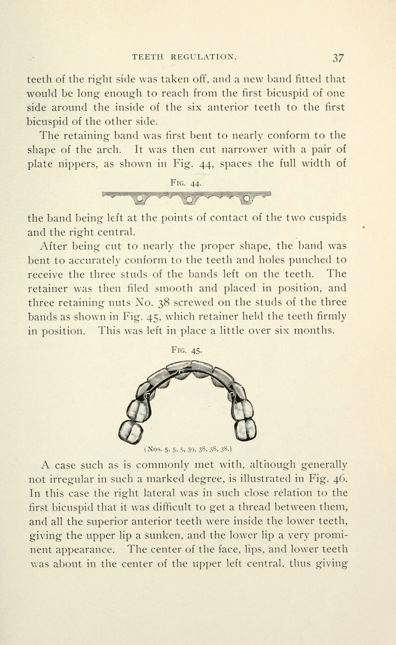 teeth of the right side was taken off, and a new band fitted that would be long enough to reach from the first bicuspid of one side around the inside of the six anterior teeth to the first bicuspid of the other side. The retaining band was first bent to nearly conform to the shape of the arch. It was then cut narrower with a pair of plate nippers, as shown in Fig. 44, spaces the full width of Fig. 44. the band being left at the points of contact of the two cuspids and the right central. After being cut to nearly the proper shape, the band was bent to accurately conform to the teeth and holes punched to receive the three studs of the bands left on the teeth. The retainer was then filed smooth and placed in position, and three retaining nuts No. 38 screwed on the studs of the three bands as shown in Fig. 45, which retainer held the teeth firmly in position. This was left in place a little over six months. Fig. 45. (Nos. 5, 5,5, 39, 38,38, 38.) A case such as is commonly met with, although generally not irregular in such a marked degree, is illustrated in Fig. 46. In this case the right lateral was in such close relation to the first bicuspid that it was difficult to get a thread between them, and all the superior anterior teeth were inside the lower teeth, giving the upper lip a sunken, and the lower lip a very promi- nent appearance. The center of the face, lips, and lower teeth Vv'as about in the center of the upper left central, thus giving