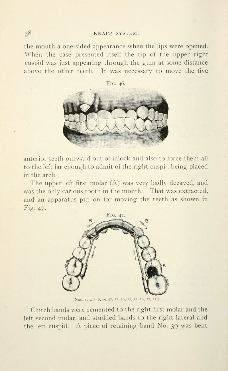 the mouth a one-sided appearance when the lips were opened. When the case presented itself the tip of the upper right cuspid was just appearing through the gum at some distance above the other teeth. It was necessary to move the five Fig. 46. anterior teeth outward out of inlock and also to force them all to the left far enough to admit of the right cuspir'. being placed in the arch. The upper left first molar (A) was very badly decayed, and was the only carious tooth in the mouth. That was extracted, and an apparatus put on for moving the teeth as shown in Fig. 47- Fig. 47. (Nos. 8, 3, 5, 8, 39, 27, 27, 19, 22,-22, 19, 22, 22.) Clutch bands were cemented to the right first molar and the left second molar, and studded bands to the right lateral and the left cuspid. A piece of retaining band No. 39 was bent