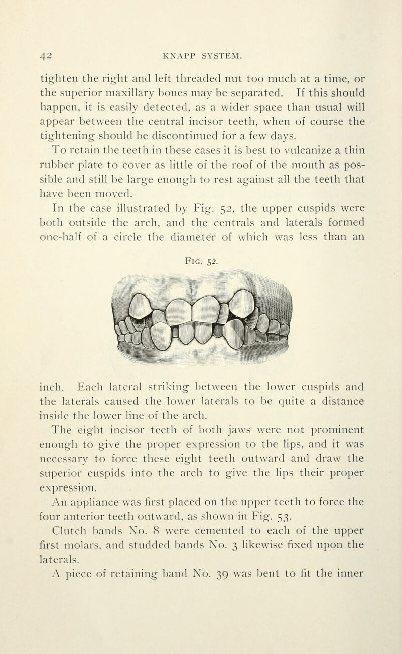 tighten the right and left threaded nut too much at a time, or the superior maxillary bones may be separated. If this should happen, it is easily detected, as a wider space than usual will appear between the central incisor teeth, when of course the tightening should be discontinued for a few days. To retain the teeth in these cases it is best to vulcanize a thin rubber plate to cover as little of the roof of the mouth as pos- sible and still be large enough to rest against all the teeth that have been moved. In the case illustrated by Fig. 52, the upper cuspids were both outside the arch, and the centrals and laterals formed one-half of a circle the diameter of which was less than an Fig. 52. inch. Each lateral striking between the lower cuspids and the laterals caused the lower laterals to be quite a distance inside the lower line of the arch. The eight incisor teeth of both jaws were not prominent enough to give the proper expression to the lips, and it was necessary to force these eight teeth outward and draw the superior cuspids into the arch to give the lips their proper expression. An appliance was first placed on the upper teeth to force the four anterior teeth outward, as .'^hown in Fig. 53. Clutch bands No. 8 were cemented to each of the upper first molars, and studded bands No. 3 likewise fixed upon the laterals. A piece of retaining band No. 39 was bent to fit the inner