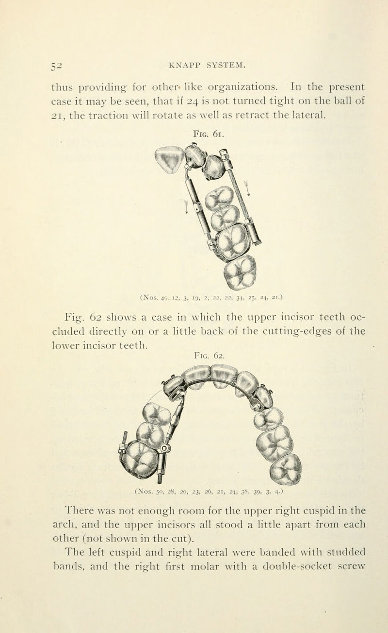 0- thus providing for other like organizations. In the present case it may be seen, that if 24 is not turned tight on tlie ball of 21, the traction will rotate as well as retract the lateral. Fig. 61. (NOS. 49, 12, 3, 19, 2, 34, 25, 24, 21.) Fig. 62 shows a case in which the upper incisor teeth oc- cluded directly on or a little back of the cutting-edges of the lowTr incisor teeth. Fig. 62. (Nos. 50, 2S, 20, 23, 26, 21, 24, 3S 39, 3, 4 ) There was not enough room for the upper right cuspid in the arch, and the upper incisors all stood a little apart from each other (not shown in the cut). The left cuspid and right lateral were banded with studded bands, and the right first molar with a double-socket screw