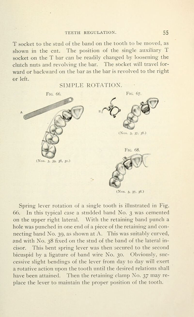 T socket to the stud of the band on the tooth to be moved, as shown in the cut. The position of the single auxihary T socket on the T bar can be readily changed by loosening the clutch nuts and revolving the bar. The socket will travel for- ward or backward on the bar as the bar is revolved to the right or left. SIMPLE ROTATION. Fig. 66. Fig. 67. (Nos. 3, 39, 38, 30.) (Nos. 3, 37, 38.) Fig. 68. (Nos. 3, 37, 38-) Spring lever rotation of a single tooth is illustrated in Fig. 66. In this typical case a studded band No. 3 was cemented on the upper right lateral. With the retaining band punch a hole was punched in one end of a piece of the retaining and con- necting band No. 39, as shown at A. This was suitably curved, and with No. 38 fixed on the stud of the band of the lateral in- cisor. This bent spring lever was then secured to the second bicuspid by a ligature of band wire No. 30. Obviously, suc- cessive slight bendings of the lever from day to day will exert a rotative action upon the tooth until the desired relations shall have been attained. Then the retaining clamp No. 37 may re- place the lever to maintain the proper position of the tooth.