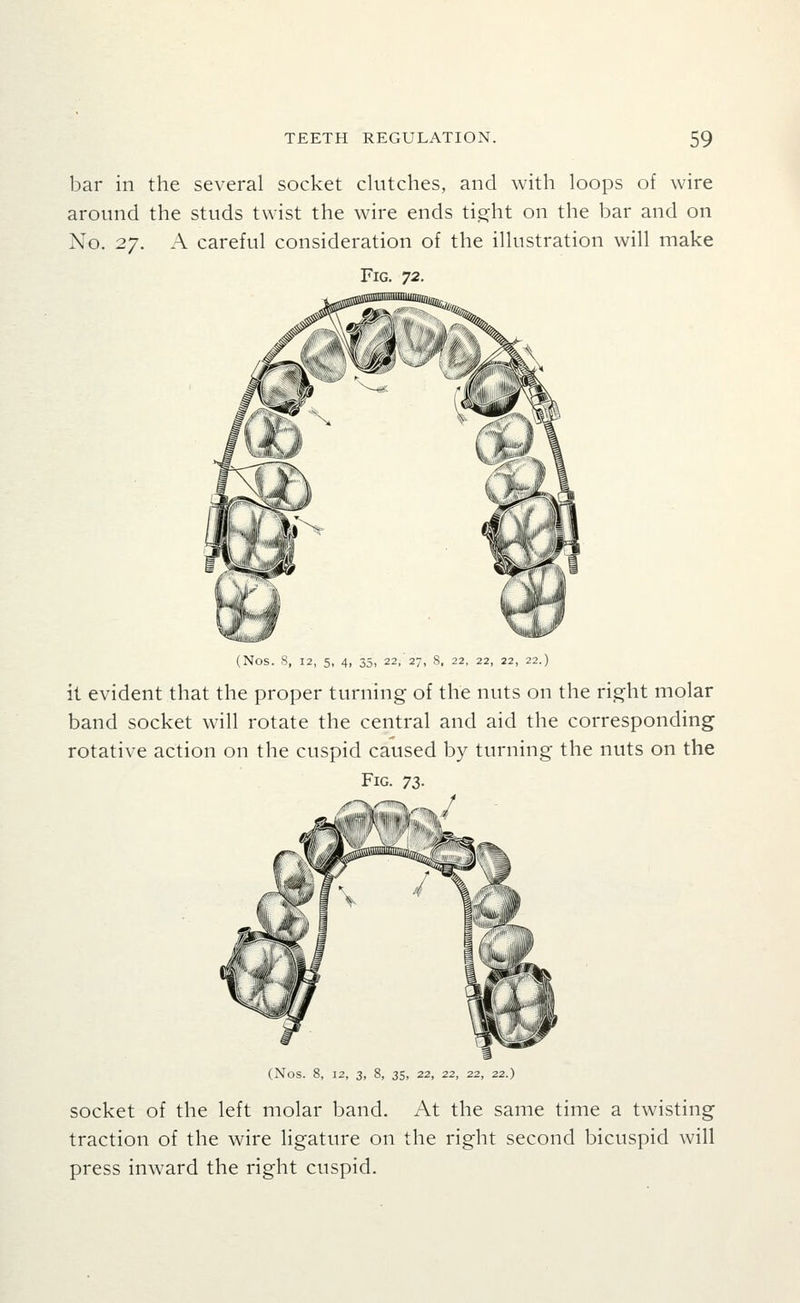 bar in the several socket clutches, and with loops of wire around the studs twist the wire ends tig^ht on the bar and on No. 2.^. A careful consideration of the illustration will make Fig. 72. (Nos. S, 12, 5, 4, 35, 22, 27, 8, 22, 22, 22, 22.) it evident that the proper turning of the nuts on the right molar band socket will rotate the central and aid the corresponding rotative action on the cuspid caused by turning the nuts on the Fig. yz. J (Nos. 8, 12, 3, 8, 35, 22, 22, 22, 22.) socket of the left molar band. At the same time a twisting traction of the wire ligature on the right second bicuspid will press inward the right cuspid.