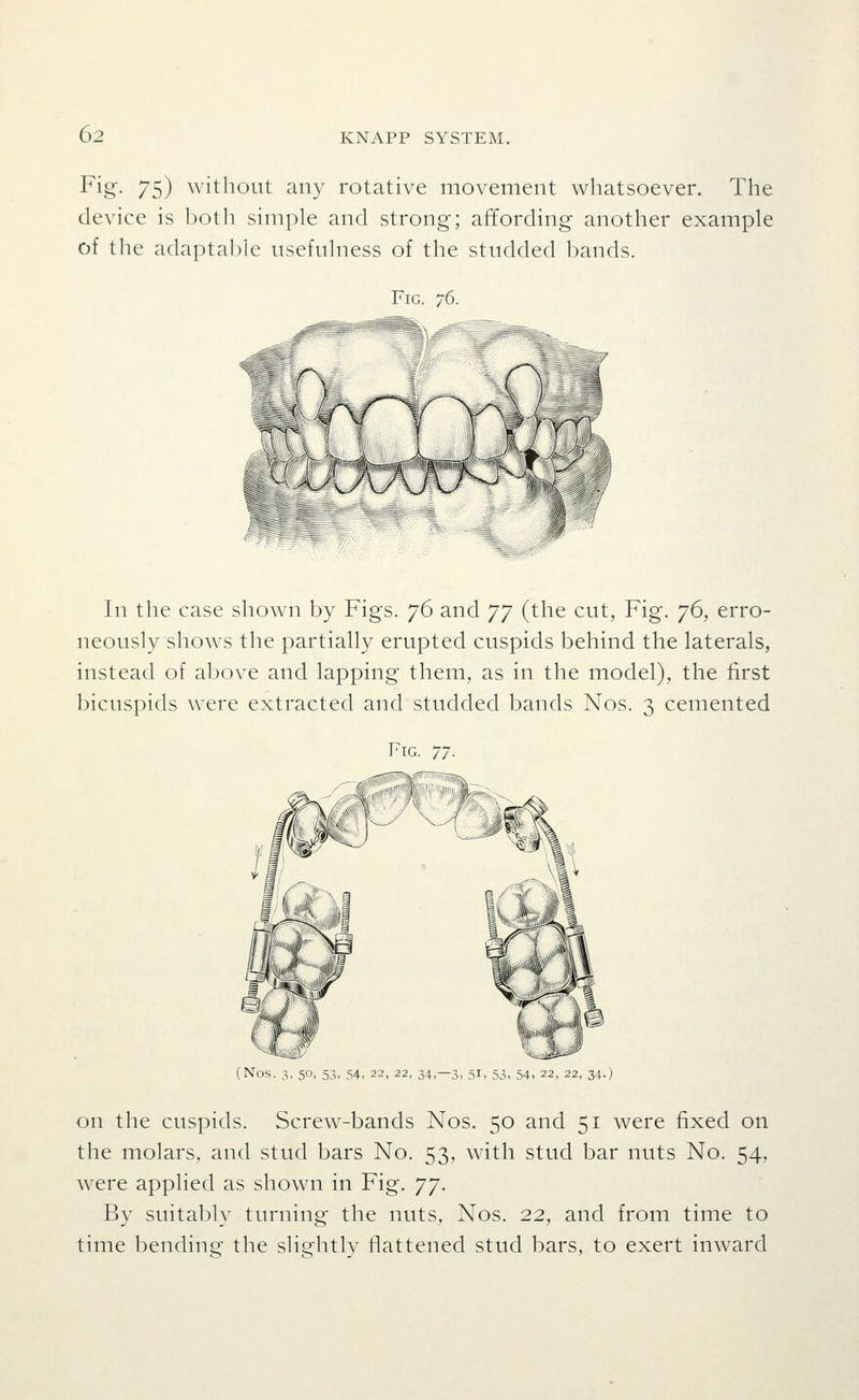 ^i§'- 75) without any rotative movement whatsoever. The device is both simple and strong; affording another example of the adaptable usefulness of the studded bands. In the case shown by Figs. 76 and yj (the cut, Fig. 76, erro- neously shows the partially erupted cuspids behind the laterals, instead of above and lapping them, as in the model), the first bicuspids were extracted and studded bands Nos. 3 cemented (Nos. 3, 50, 53, 54, 22, 22, 34,-3, 51, 53, 54, 22, 22, 34.) on the cuspids. Screw-bands Nos. 50 and 51 were fixed on the molars, and stud bars No. 53, with stud bar nuts No. 54, were applied as shown in Fig. 'jj. By suitably turning the nuts, Nos. 22, and from time to time bending the slightly flattened stud bars, to exert inward