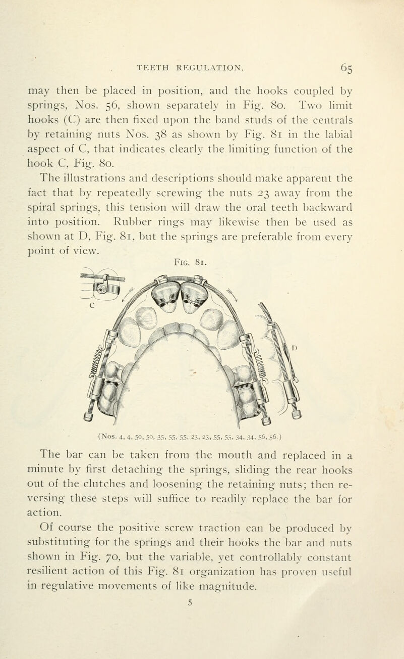 may then be placed in position, and the hooks coupled by- springs, Nos. 56, shown separately in Fig. 80. Two limit hooks (C) are then fixed upon the band studs of the centrals by retaining nuts Nos. 38 as shown by Fig. 81 in the labial aspect of C, that indicates clearly the limiting function of the hook C, Fig. 80. The illustrations and descriptions should make apparent the fact that by repeatedly screwing the nuts 23 away from the spiral springs, this tension will draw the oral teeth backward into position. Rubber rings may likewise then be used as shown at D, Fig. 81, but the springs are preferable from every point of view. Fig. 81. (Nos. 4, 4, 50, 50, 35, 55, 55, 23, 23, 55, 55, 34, 34, 56, 56.) The bar can be taken from the mouth and replaced in a minute by first detaching the springs, sliding the rear hooks out of the clutches and loosening the retaining nuts; then re- versing these steps will suffice to readily replace the bar for action. Of course the positive screw traction can be produced by substituting for the springs and their hooks the bar and nuts shown in Fig. 70, but the variable, yet controllably constant resilient action of this Fig. 81 organization has proven useful in regulative movements of like magnitude. 5