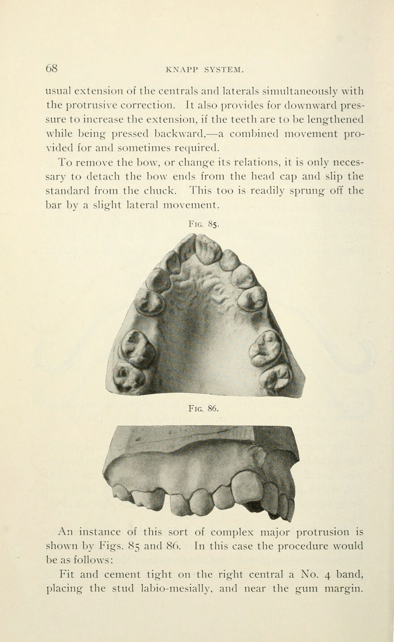 usual extension of the centrals and laterals sinuiltaneously with the protrusive correction. It also provides for downward pres- sure to increase the extension, if the teeth are to be lengthened wdiile being pressed backward,—a combined movement pro- vided for and sometimes recjuired. To remove the bow, or change its relations, it is only neces- sary to detach the bow ends from the head cap and slip the standard from the chuck. This too is readily sprung ofi the bar by a slight lateral movement. Fig. 85. Fig. 86. An instance of this sort of complex major protrusion is shown by Figs. 85 and 86. In this case the procedure would be as follows: Fit and cement tight on the right central a No. 4 band, placing the stud labio-mesially, and near the gum margin.