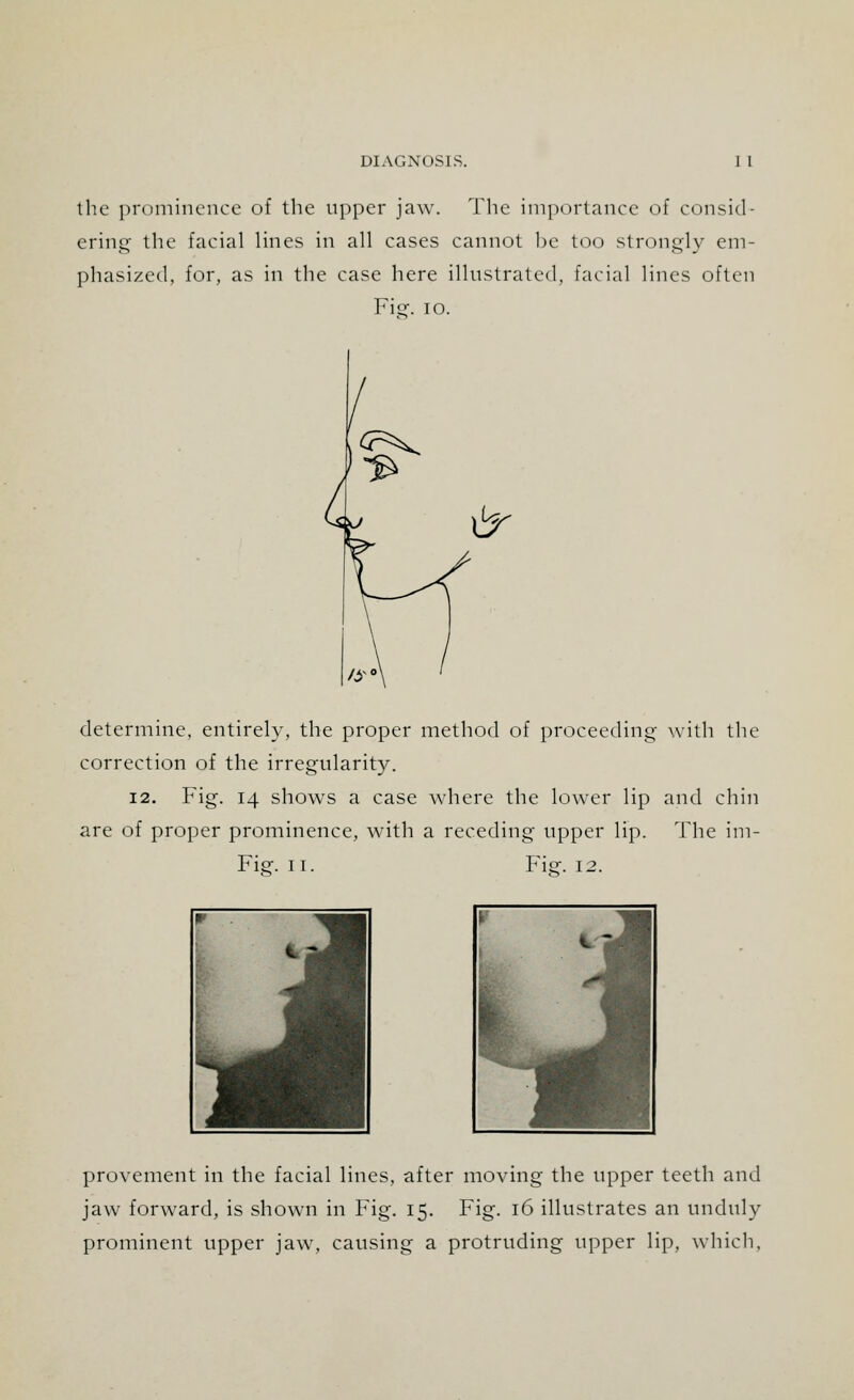 the prominence of the upper jaw. The importance of consid- ering the facial lines in all cases cannot be too strongly em- phasized, for, as in the case here illustrated, facial lines often Fier. 10. determine, entirely, the proper method of proceeding with the correction of the irregularity. 12. Fig. 14 shows a case where the lower lip and chin are of proper prominence, with a receding upper lip. The im- Fie:. 11. Figf. 12. provement in the facial lines, after moving the upper teeth and jaw forward, is shown in Fig. 15. Fig. 16 illustrates an unduly prominent upper jaw, causing a protruding upper lip, which.