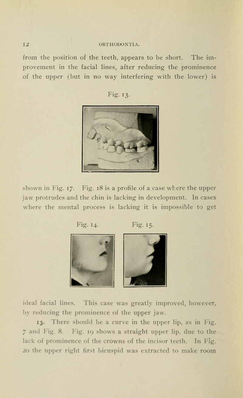 from the position of the teeth, appears to be short. The im- provement in the facial lines, after reducing- the prominence of the upper I lint in no way interfering 'with the lower) is Fig- 13- shown in Fig. 17. Fig. [8 is a profile of a case where the upper jaw protrudes and the chin is lacking in development. In cases where the mental process is lacking it is impossible to get Fig. 14. Fig. 15. ideal facial lines. This case was greatly improved, however, by reducing the prominence of the upper jaw. 13. There should be a curve in the upper lip, as in Fig. 7 and Fig. 8. Fig. [9 -hows a straighl upper lip, due to the of prominence of the crowns of the incisor teeth. In Fig. 20 the upper right firsl bicuspid was extracted t<» make room