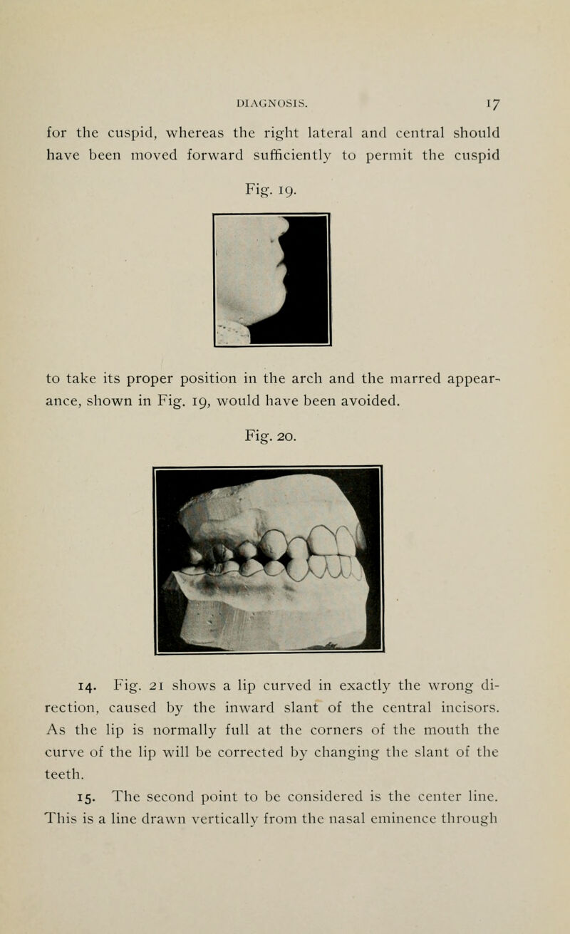 for the cuspid, whereas the right lateral and central should have been moved forward sufficiently to permit the cuspid Fig. 19. to take its proper position in the arch and the marred appear- ance, shown in Fig. 19, would have been avoided. Fief. 20. 14. Fig. 21 shows a lip curved in exactly the wrong di- rection, caused by the inward slant of the central incisors. As the lip is normally full at the corners of the mouth the curve of the lip will be corrected by changing the slant of the teeth. 15. The second point to be considered is the center line. This is a line drawn vertically from the nasal eminence through