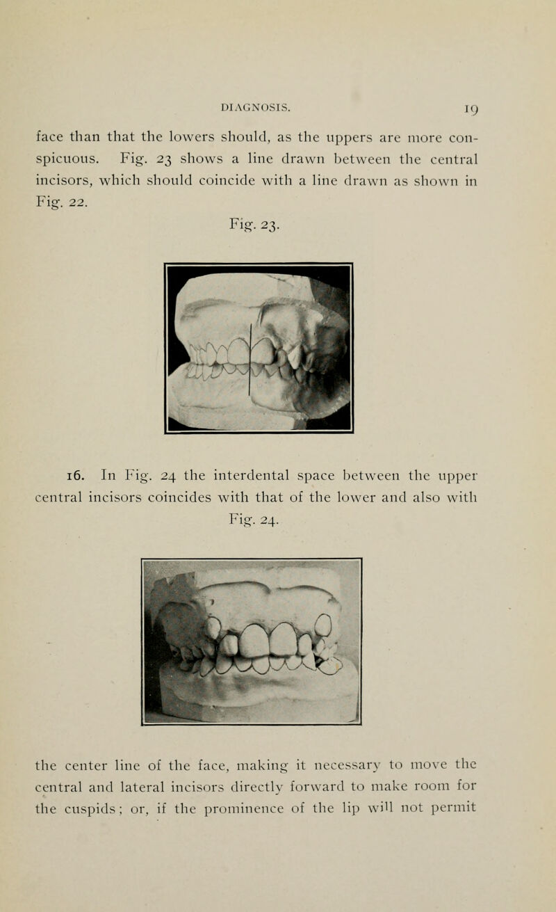 face than that the lowers should, as the uppers are more con- spicuous. Fig. 23 shows a line drawn between the central incisors, which should coincide with a line drawn as shown in Fig. 22. Fig. 23. 16. In Fig. 24 the interdental space between the upper central incisors coincides with that of the lower and also with Fig. 24. the center line of the face, making it necessary to move the central and lateral incisors directly forward to make room for the cuspids; or, if the prominence of the lip will not permit