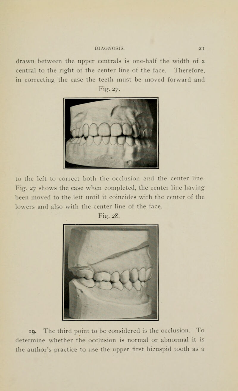 drawn between the upper centrals is one-half the width of a central to the right of the center line of the face. Therefore, in correcting the case the teeth must be moved forward and Fig. 27. to the left to correct both the occlusion and the center line. Fig. 27 shows the case when completed, the center line having been moved to the left until it coincides with the center of the lowers and also with the center line of the face. Fie. 28. 19. The third point to be considered is the occlusion. To determine whether the occlusion is normal or abnormal it is the author's practice to use the upper first bicuspid tooth as a