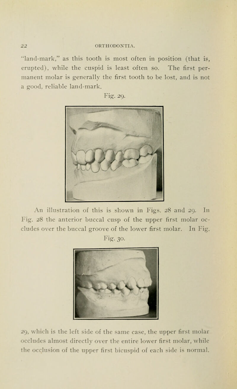 land-mark, as this tooth is most often in position (that is, erupted), while the cuspid is least often so. The first per- manent molar is generally the first tooth to he lost, and is not a good, reliahle land-mark. Fig. 20. An illustration of this is shown in Figs. 28 and 29. In Fig. 28 the anterior buccal cusp of the upper first molar oc- cludes over the buccal groove of the lower first molar. In Fig. Fig. 30. 29, which is the left side of the same case, the upper first molar occludes almost directly over the entire lower first molar, while the occlusion of the upper firsl bicuspid of each side is normal.
