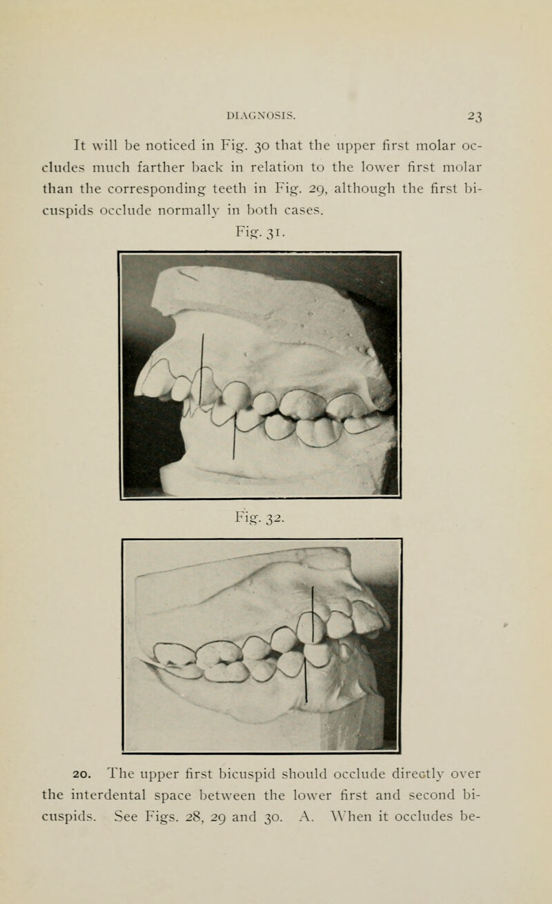It will be noticed in Fig. 30 that the upper first molar oc- cludes much farther back in relation to the lower first molar than the corresponding teeth in Fig. 29, although the first bi- cuspids occlude normally in both cases. Fig. 31. Fig. 32. 20. The upper first bicuspid should occlude directly over the interdental space between the lower first and second bi- cuspids. See Figs. 28, 29 and 30. A. When it occludes be-