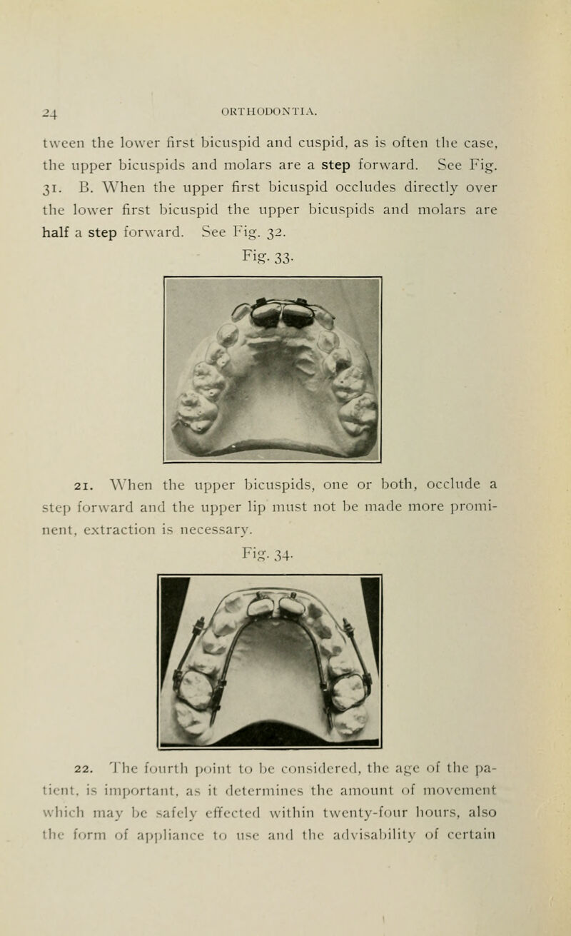 twcen the lower first bicuspid and cuspid, as is often the case, the upper bicuspids and molars are a step forward. See Fig. 31. B. When the upper first bicuspid occludes directly over the lower first bicuspid the upper bicuspids and molars are half a step forward. See Fig. 32. Fig- 33- 21. When the upper bicuspids, one or both, occlude a step forward and the upper lip must not be made more promi- nent, extraction is necessary. Fig. 34- 22. The fourth point to be considered, the age of th< pa ii<-nt. i> important. a> it determines the amounl of movement which may be safel) effected within twenty-four hours, also the form of appliance to use and the advisability of certain