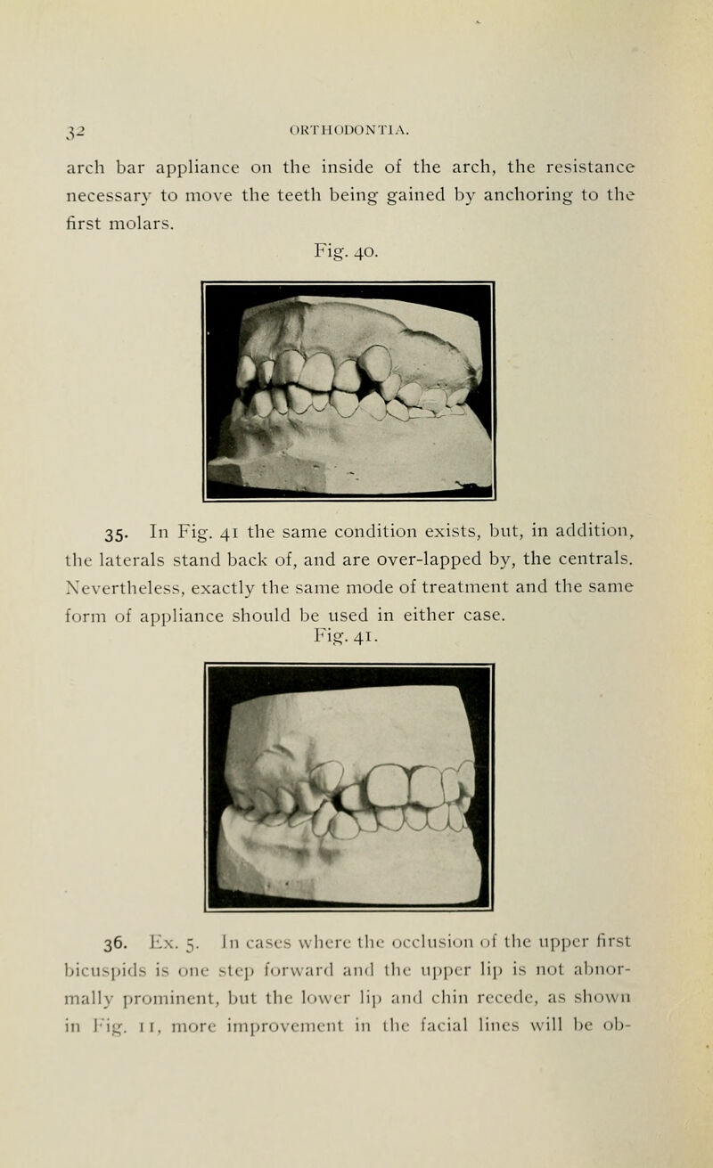 arch bar appliance on the inside of the arch, the resistance necessary to first molars. necessary to move the teeth being' gained by anchoring to the Fig. 40. 35. In Fig. 41 the same condition exists, but, in addition, the laterals stand back of, and are over-lapped by, the centrals. Nevertheless, exactly the same mode of treatment and the same form of appliance should be used in either case. Fig. 41. 36. Ex. 5. In cases when- the occlusion of tin- upper firsl bicuspids IS one Step forward ami the upper lip is not abnor- mally prominent, but the lower lip and (bin recede, as shown in Fig. 11. more improvement in the facial lines will be ob
