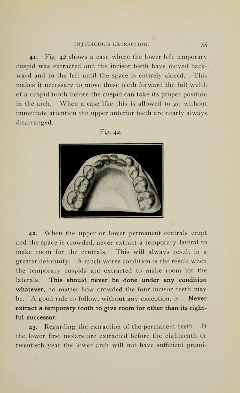 41. Fig. 42 shows a case where the lower left temporary cuspid was extracted and the incisor teeth have moved back- ward and to the left until the space is entirely closed. This makes it necessary to move these teeth forward the full width of a cuspid tooth before the cuspid can take its proper position in the arch. When a case like this is allowed to go without immediate attention the upper anterior teeth are nearly always disarranged. Fig. 42. 42. When the upper or lower permanent centrals erupt and the space is crowded, never extract a temporary lateral to make room for the centrals. This will always result in a greater deformity. A much worse condition is the result when the temporary cuspids are extracted to make room for the laterals. This should never be done under any condition whatever, no matter how crowded the four incisor teeth may be. A good rule to follow, without any exception, is : Never extract a temporary tooth to give room for other than its right- ful successor. 43. Regarding the extraction of the permanent teeth. If the lower first molars are extracted before the eighteenth or twentieth year the lower arch will not have sufficient promi-