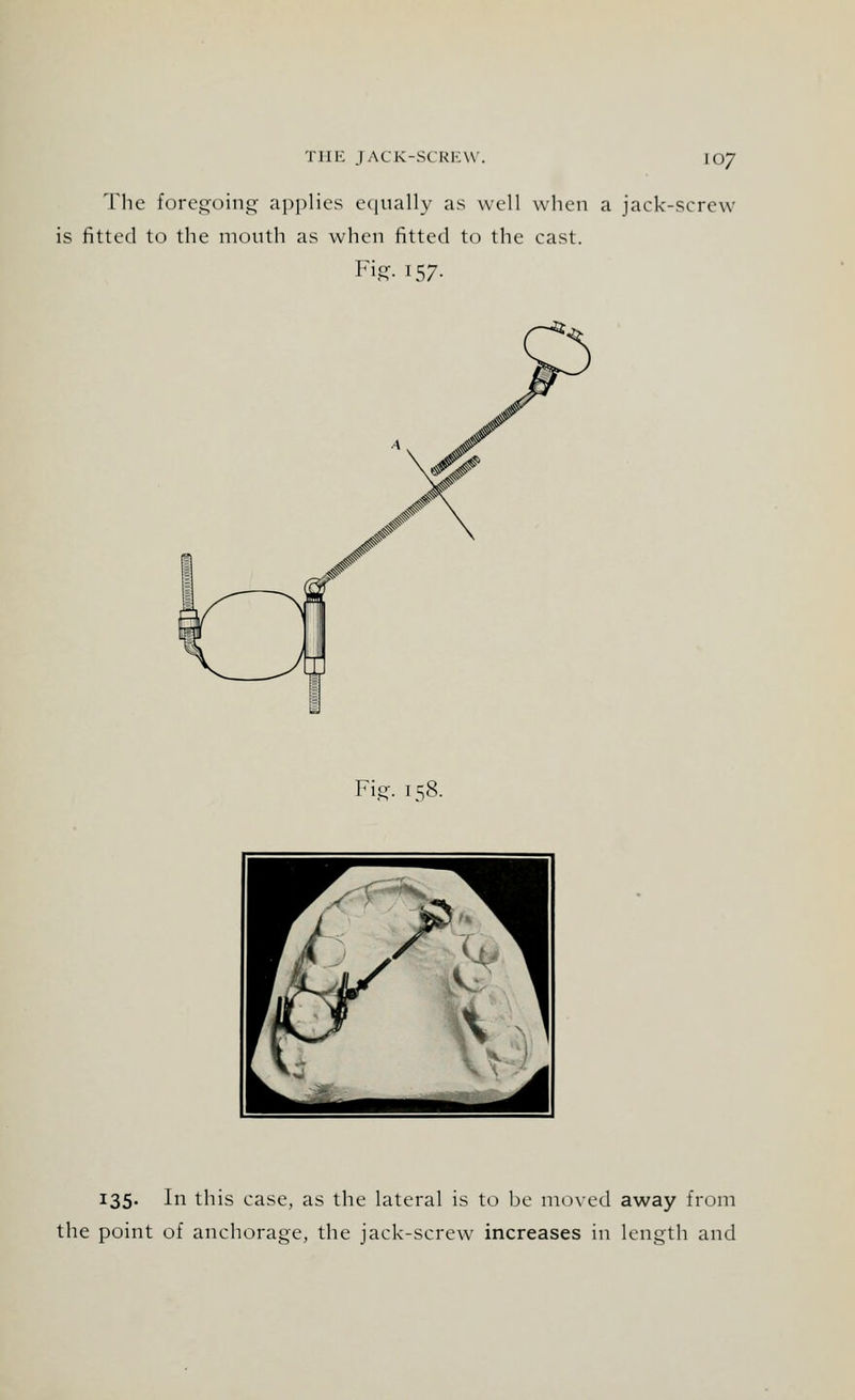 The foregoing applies equally as well when a jack-screw is fitted to the mouth as when fitted to the cast. Fig. 157. Fig. 158. 135. In this case, as the lateral is to be moved away from the point of anchorage, the jack-screw increases in length and