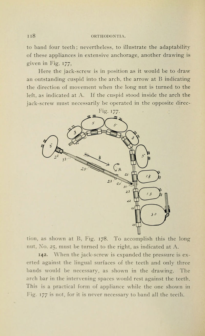 to band four teeth ; nevertheless, to illustrate the adaptability of these appliances in extensive anchorage, another drawing is given in Fig. 177, Here the jack-screw is in position as it would be to draw an outstanding cuspid into the arch, the arrow at B indicating the direction of movement when the long nut is turned to the left, as indicated at A. If the cuspid stood inside the arch the jack-screw must necessarily be operated in the opposite direc- Fig- 177- tion, as shown at B, Fig. 178. To accomplish this the long nut, No. 25, must be turned to the right, as indicated at A. 142. When the jack-screw is expanded the pressure is ex- erted against the lingual surfaces of the teeth and only three bands would be necessary, a> shown in the drawing. The arch bar in the intervening spaces would rest against the teeth. This is a practical form of appliance while the one shown in Fig. 177 is not, for h is never necessarj to hand all the teeth.