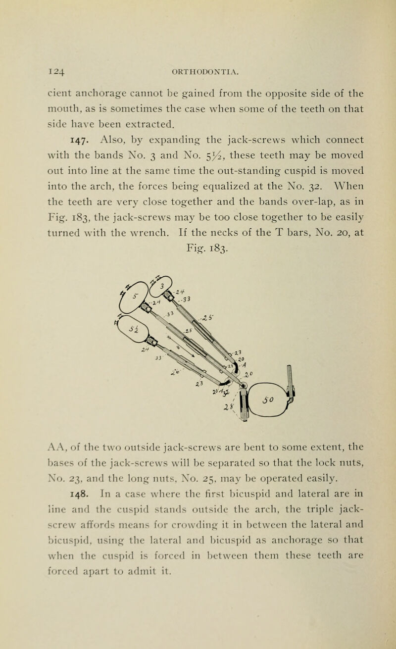cient anchorage cannot be gained from the opposite side of the month, as is sometimes the case when some of the teeth on that side have been extracted. 147. Also, by expanding the jack-screws which connect with the bands Xo. 3 and Xo. ^l/2, these teeth may be moved out into line at the same time the out-standing cuspid is moved into the arch, the forces being ecjualized at the Xo. 32. When the teeth are very close together and the bands over-lap, as in Fig. 183, the jack-screws may be too close together to be easily turned with the wrench. If the necks of the T bars, XTo. 20, at Fig. 183. AA, of the two outside jack-screws are bent to some extent, the bases of the jack-screws will be separated so that the luck nuts, No. 23. and the long nuts. Xo. 2^. may be operated easily. 148. In a case where the first bicuspid and lateral are in line and the cuspid -lands outside the arch, the triple jack- SCrew affords means for crowding it in between the lateral and bicuspid, using the lateral and bicuspid as anchorage so that when the cuspid is forced in between them these teeth are d apart to admit it.