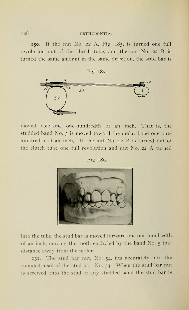 150. If the nut No. 22 A, Fig. 185. is turned one full revolution out of the clutch tube, and the nut No. 22 B is turned the same amount in the same direction, the stud bar is Fig. 185. .■..'..■.y,1..',, a.,1,.,...,.,..1, ,,,.,, 1 ■■,,■,, ,■;■:■,,',,,:,:, ,:,|,'m',',',', ,, ,:Ay.i.i,:.',',,hvy,',',Trr7r7^wro:,',:, S3 moved back one one-hundredth of an inch. That is. the studded band Xo. 5 is moved toward the molar band one one- hundredth of an inch. If the nut Xo. 22 B is turned out of the clutch tube one full revolution and nut Xo. 22 A turned Fie\ 186. into the tube, the stud bar is moved forward one one-hundredth of an inch, moving the tooth encircled by the band No. 5 that distance away from the molar. 151. The stud bar nut, No. 54, fits accurately into the rounded head of the stud bar, No. 53. When the stud bar nut is screwed onto the stud of any studded band the stud bar is
