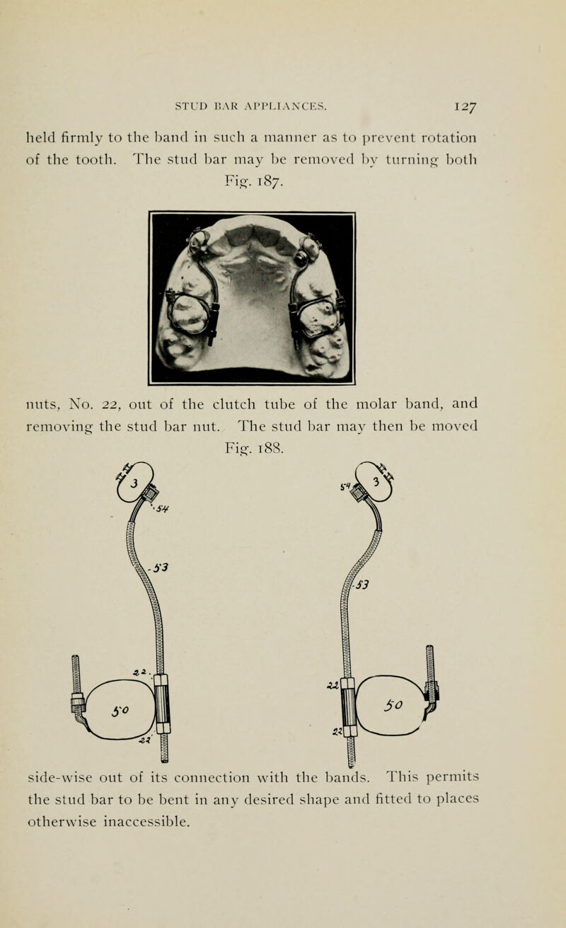 held firmly to the band in such a manner as to prevent rotation of the tooth. The stud bar may be removed by turning both Fig. 187. nuts. No. 22, out of the clutch tube of the molar band, and removing the stud bar nut. The stud bar may then be moved Fig. T88. r> side-wise out of its connection with the bands. This permits the stud bar to be bent in any desired shape and fitted to places otherwise inaccessible.